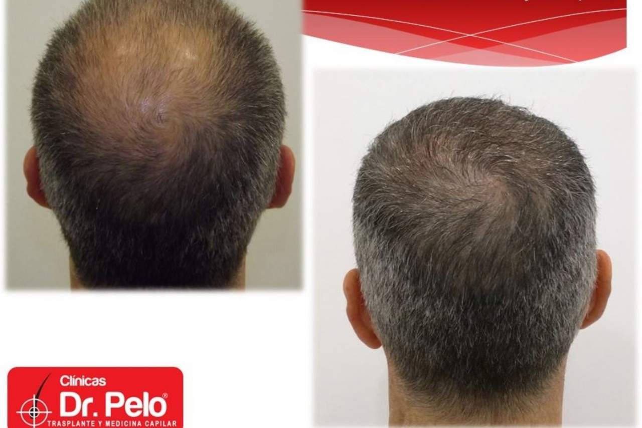 Dr. Pelo: ¿El trasplante capilar es la nueva tendencia en medicina estética?