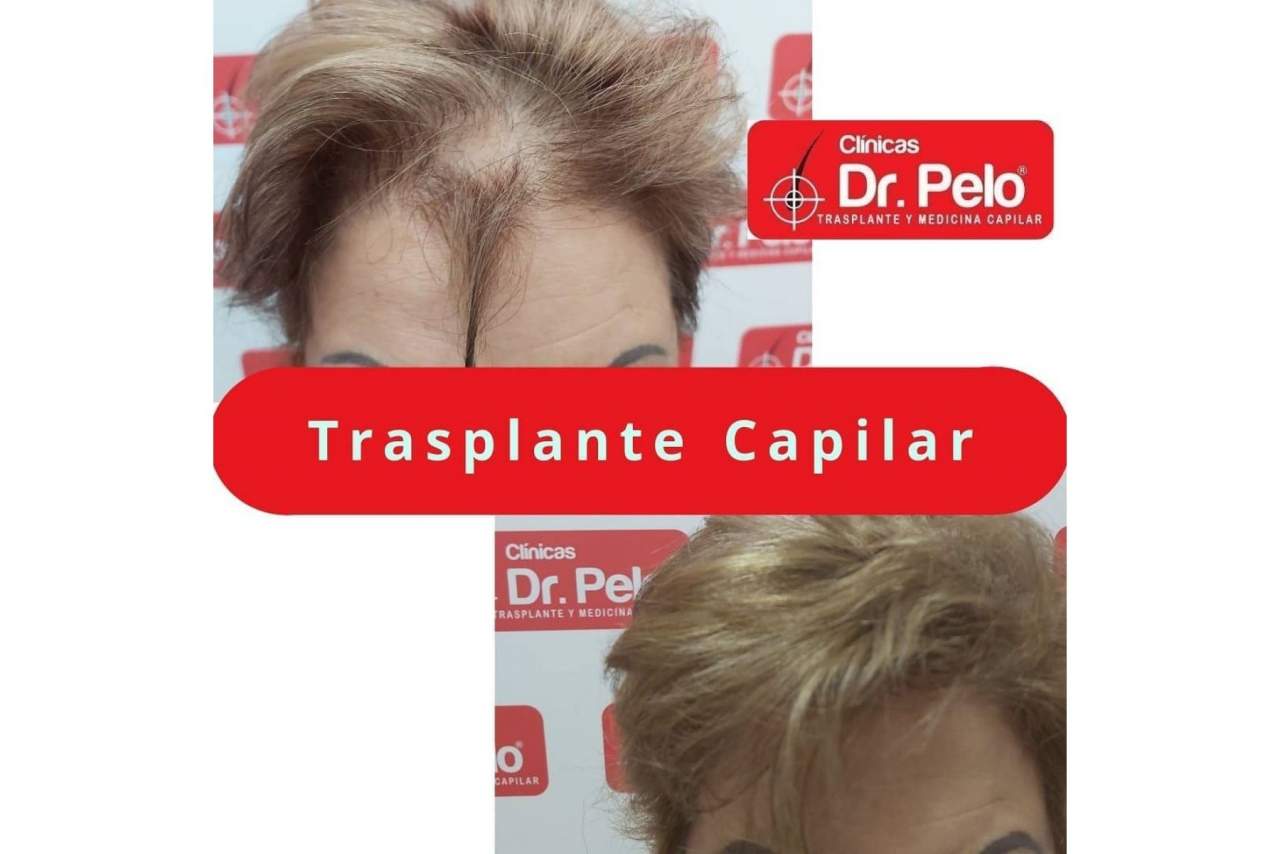 Las opiniones sobre el injerto capilar de las Clínicas Dr. Pelo en Sevilla