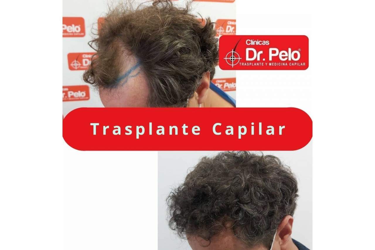 El trasplante capilar en España gana popularidad en los últimos años tras mejorar los precios y las técnica aplicadas