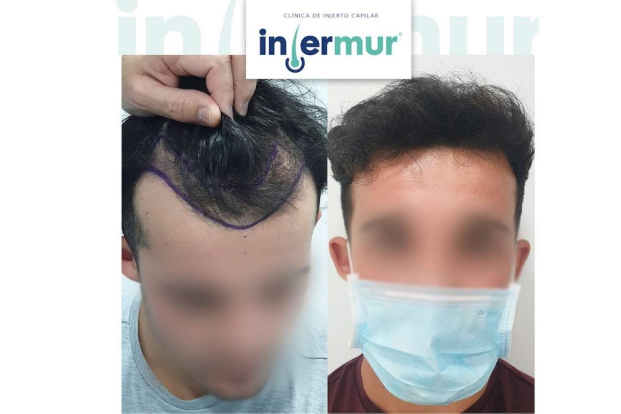 Injerto capilar en España: el pulso contra Turquía con un precio asequible y apuesta por la innovación