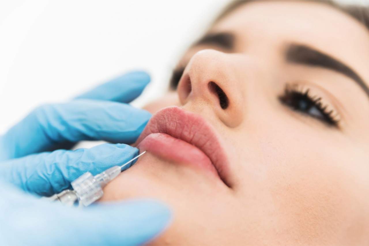 Aumento de labios en la Clínica Dr. Zito