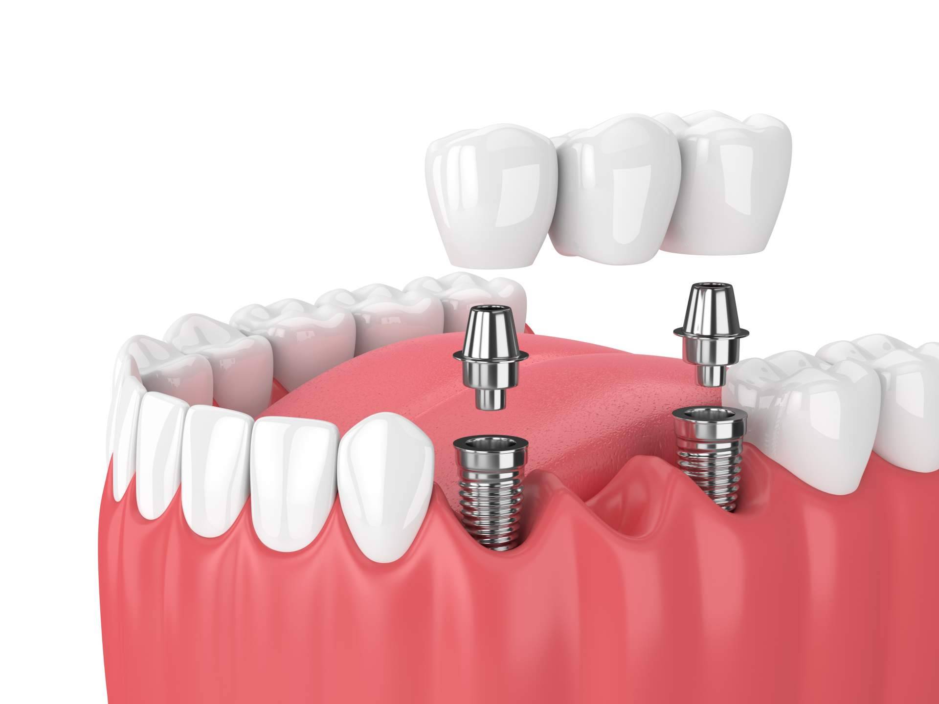 Clínica de Odontología Artydents de Madrid anuncia su implante dental de titanio por solo 199€
