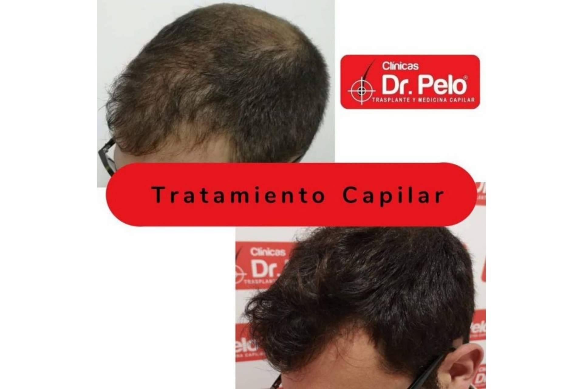 El injerto capilar en Sevilla gana popularidad gracias a las Clínicas Dr. Pelo