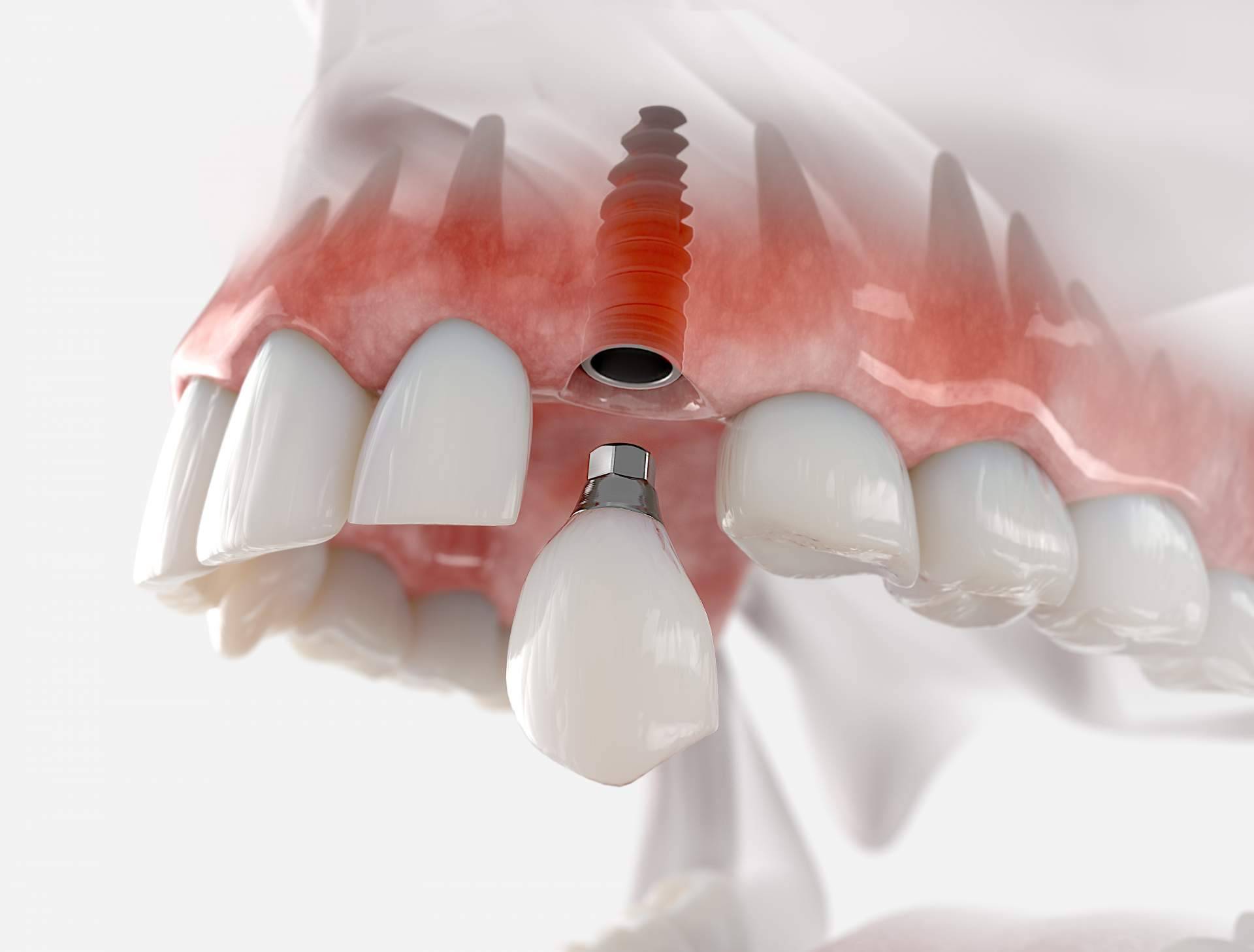 El implante dental de titanio V ha permitido recuperar la masticación y la sonrisa de miles de bocas gracias a la Clínica Artydents en Madrid