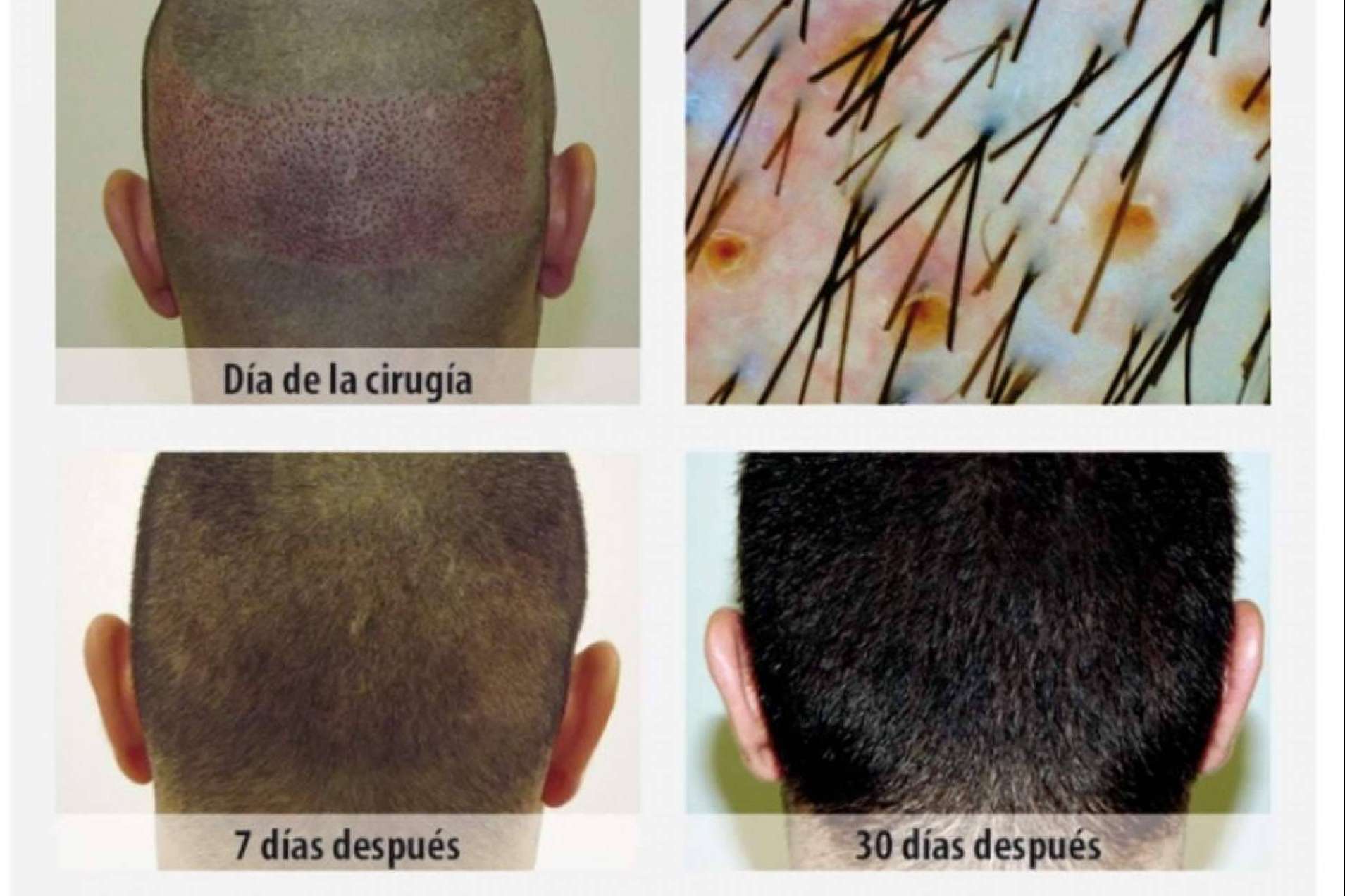 Clínica Dr.Pelo: ¿Cuál es la mejor clínica para someterse a un tratamiento de injerto capilar en Sevilla?