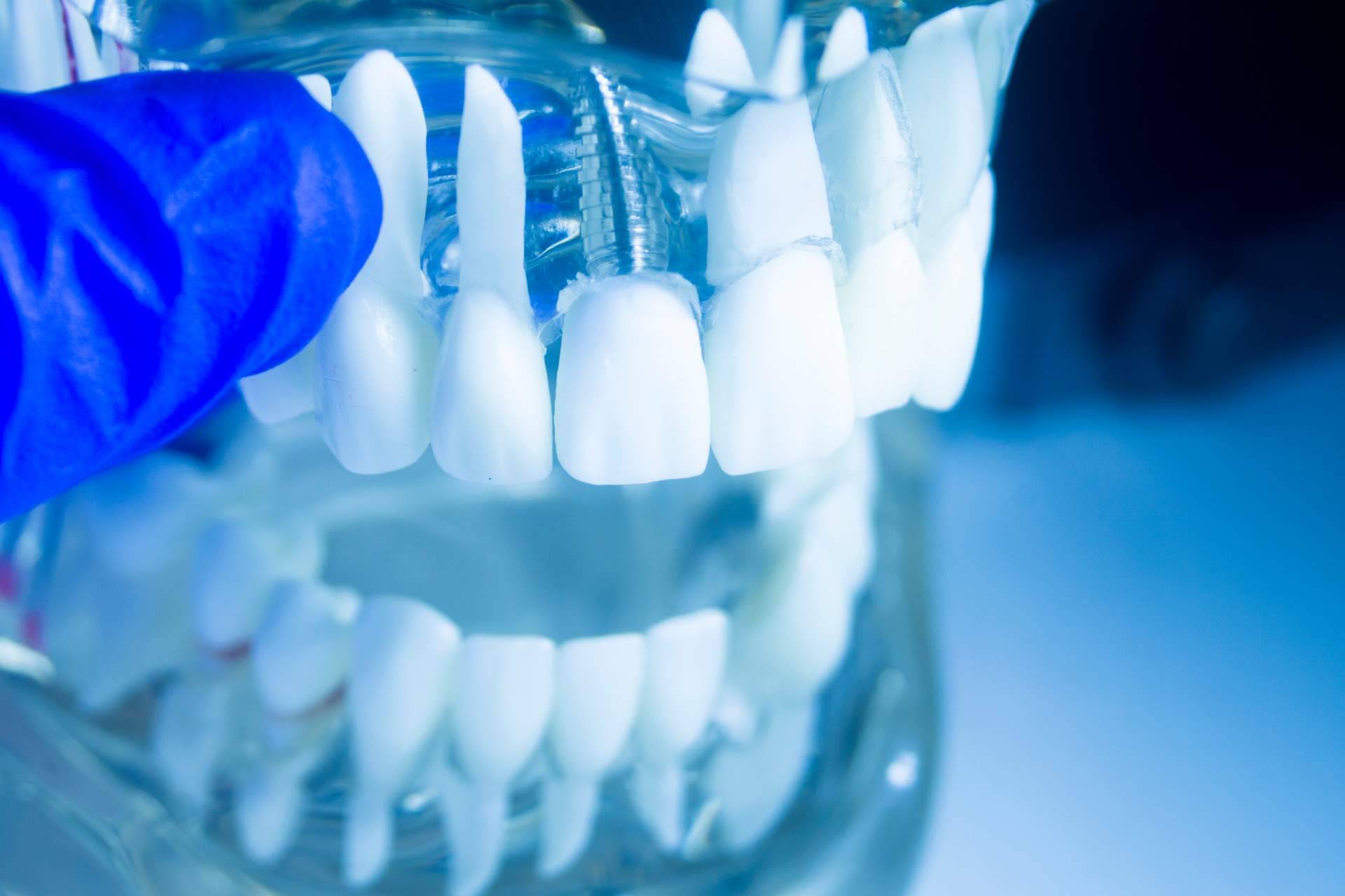 ¿Es posible tener los dientes fijos en un día? Clínica dental Artydents en Madrid