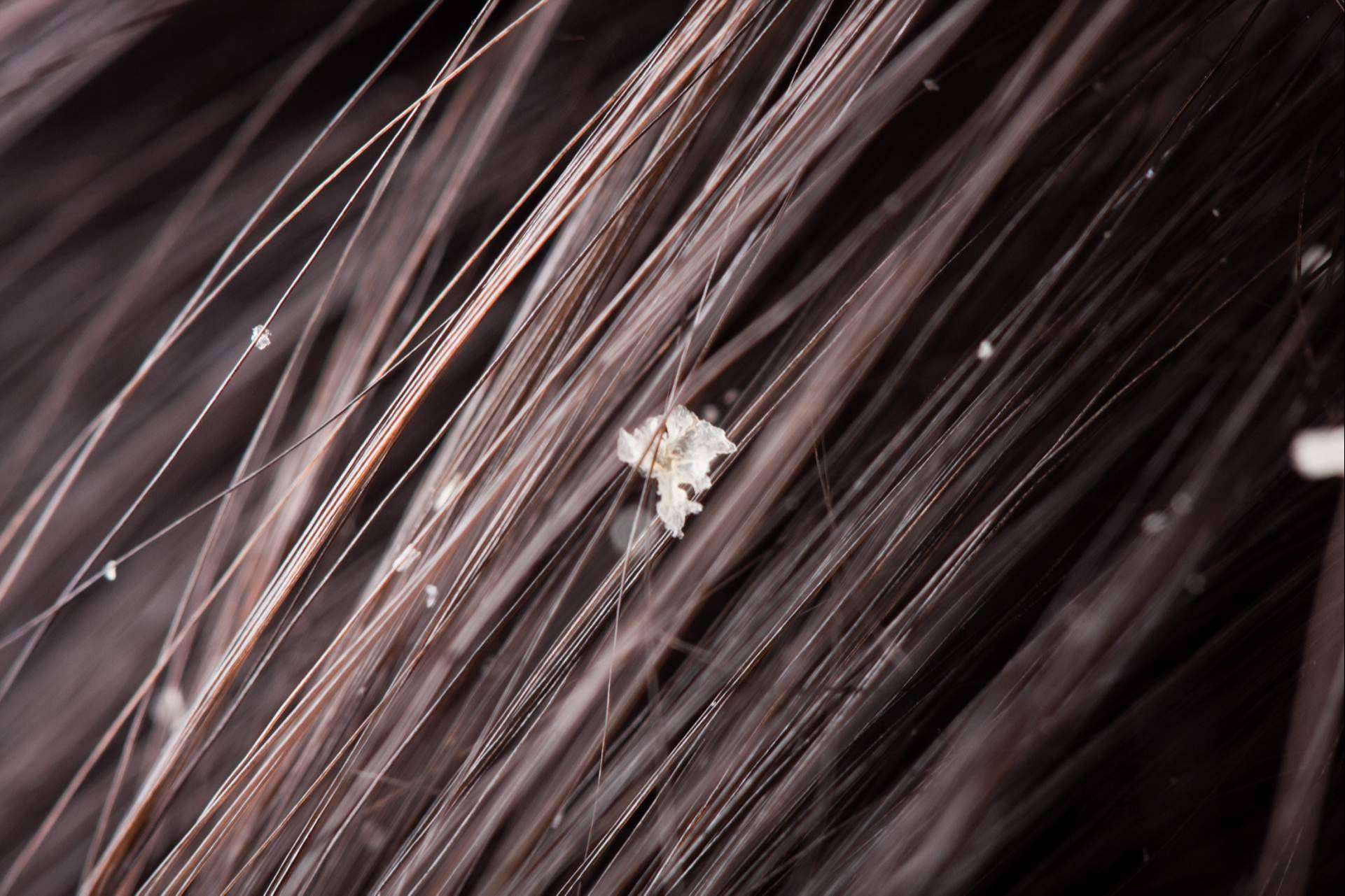 Curar costras en el cuero cabelludo, por laboratorios Géomer