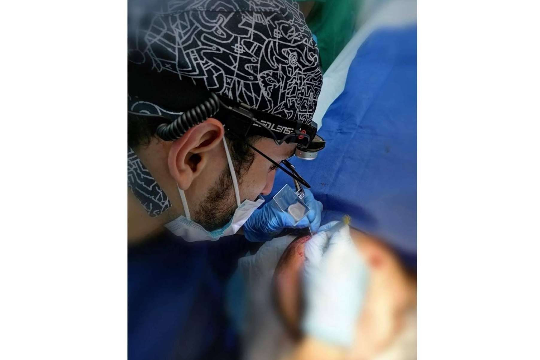 Conseguir resultados naturales en el trasplante con el Dr. Bern