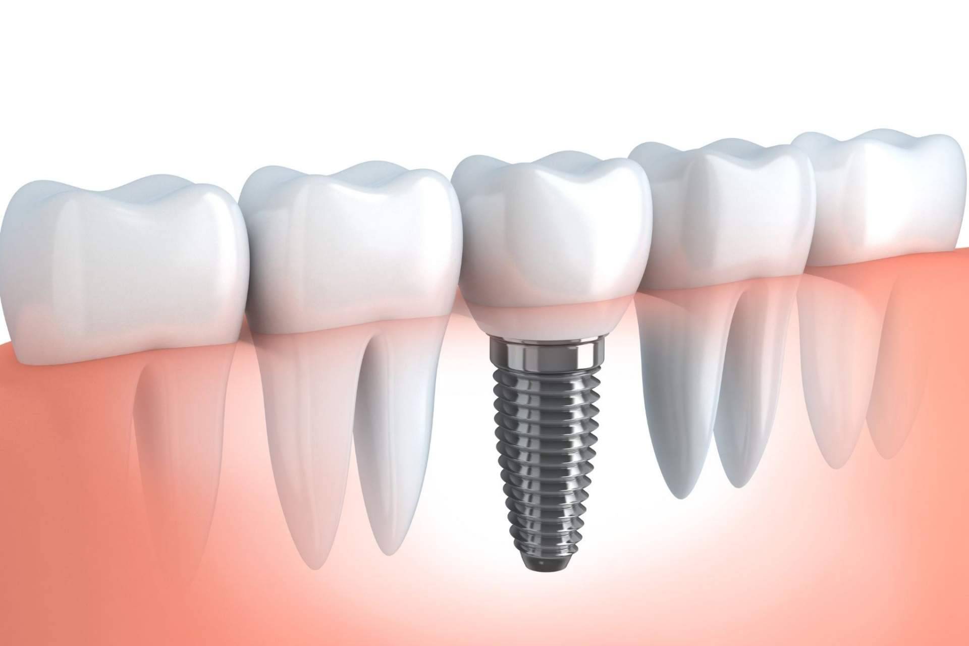 Implant Clinics: los implantes de carga inmediata
