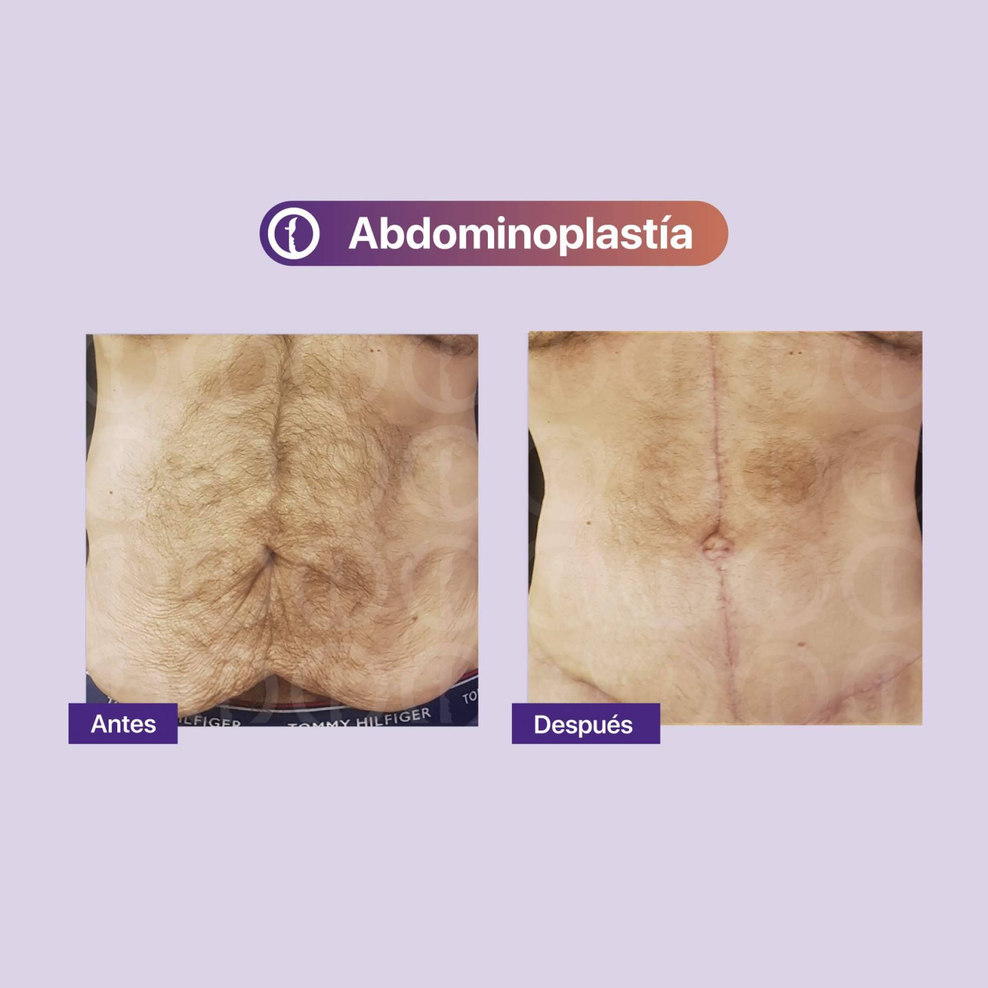 La técnica de la abdominoplastia de Clínica Tarrazo