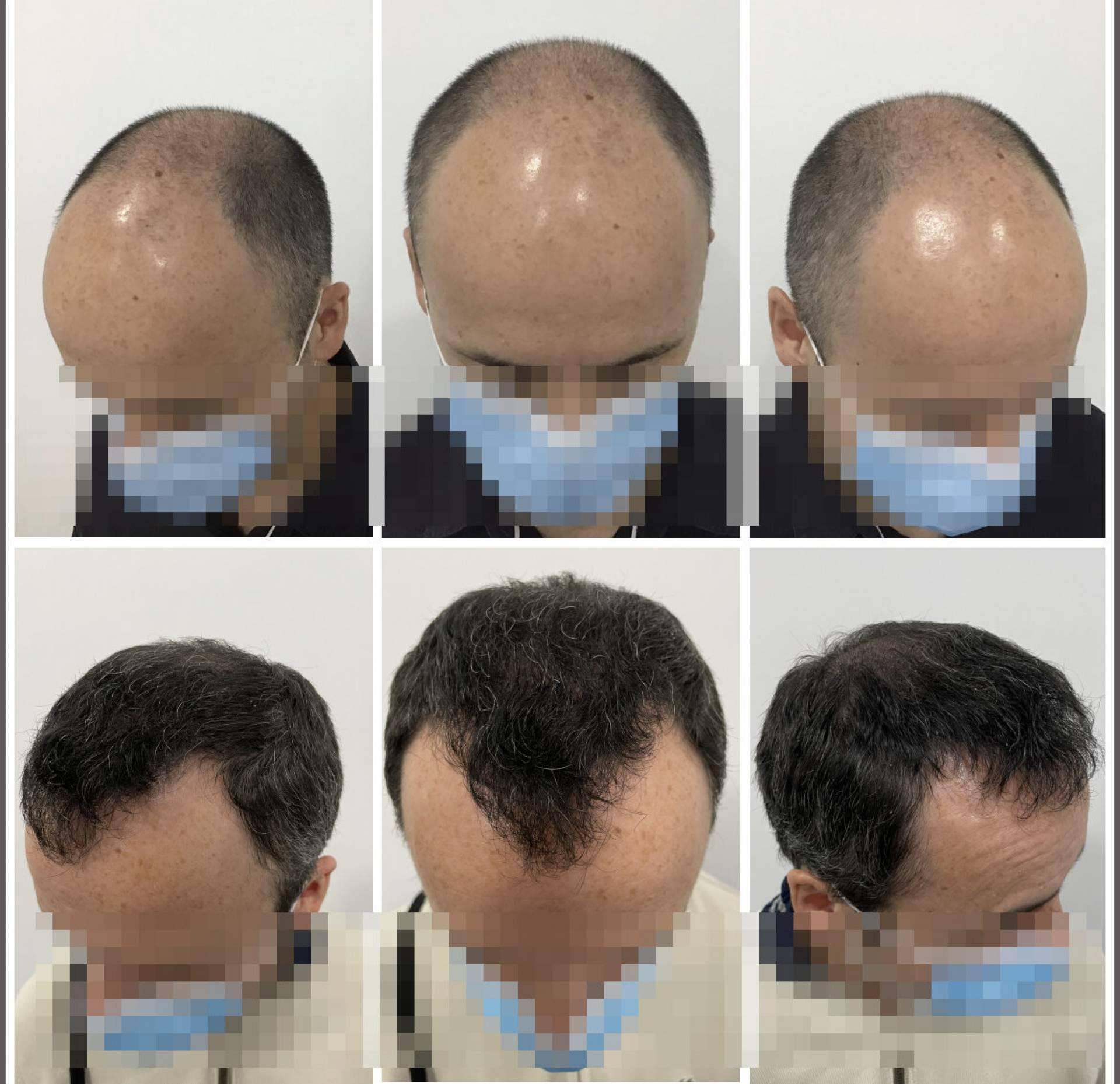 El injerto capilar más natural y denso de la mano del Dr. Bruno Jacobovski en Barcelona