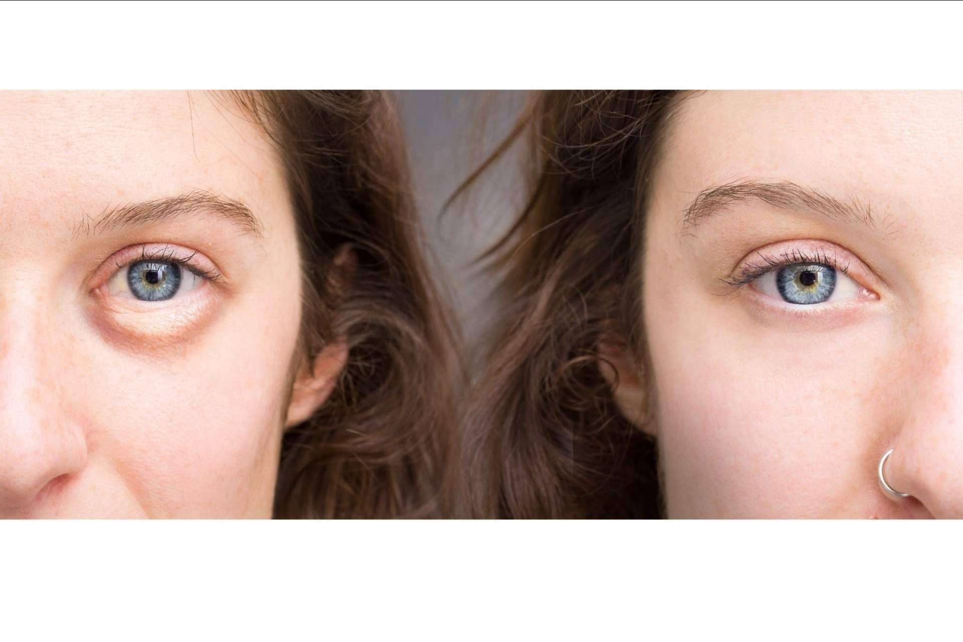 Dra. Alfonsina Uriburu: el ácido hialurónico para combatir las ojeras en la Unidad de medicina estética FEMME de Santiago de Compostela
