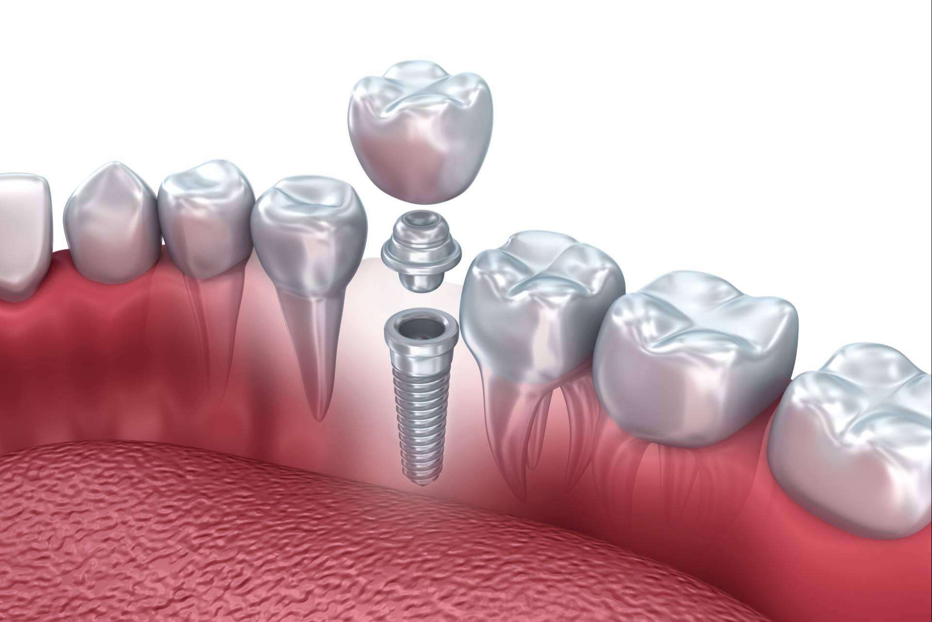 Realizarse un implante dental en Valladolid de la mano de Clínica Dental Heins