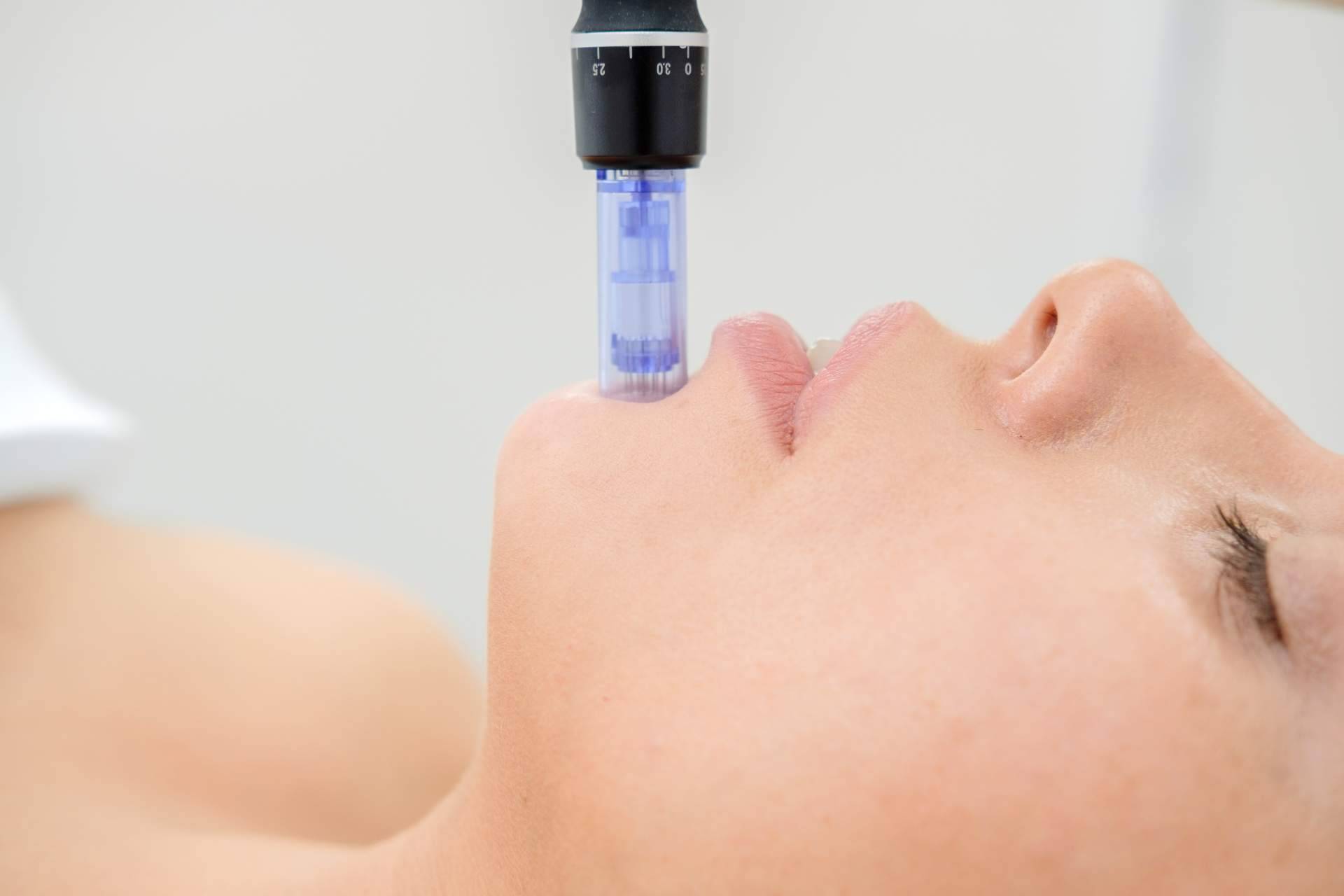 Mesoterapia facial en el centro VG Virginia Gómez