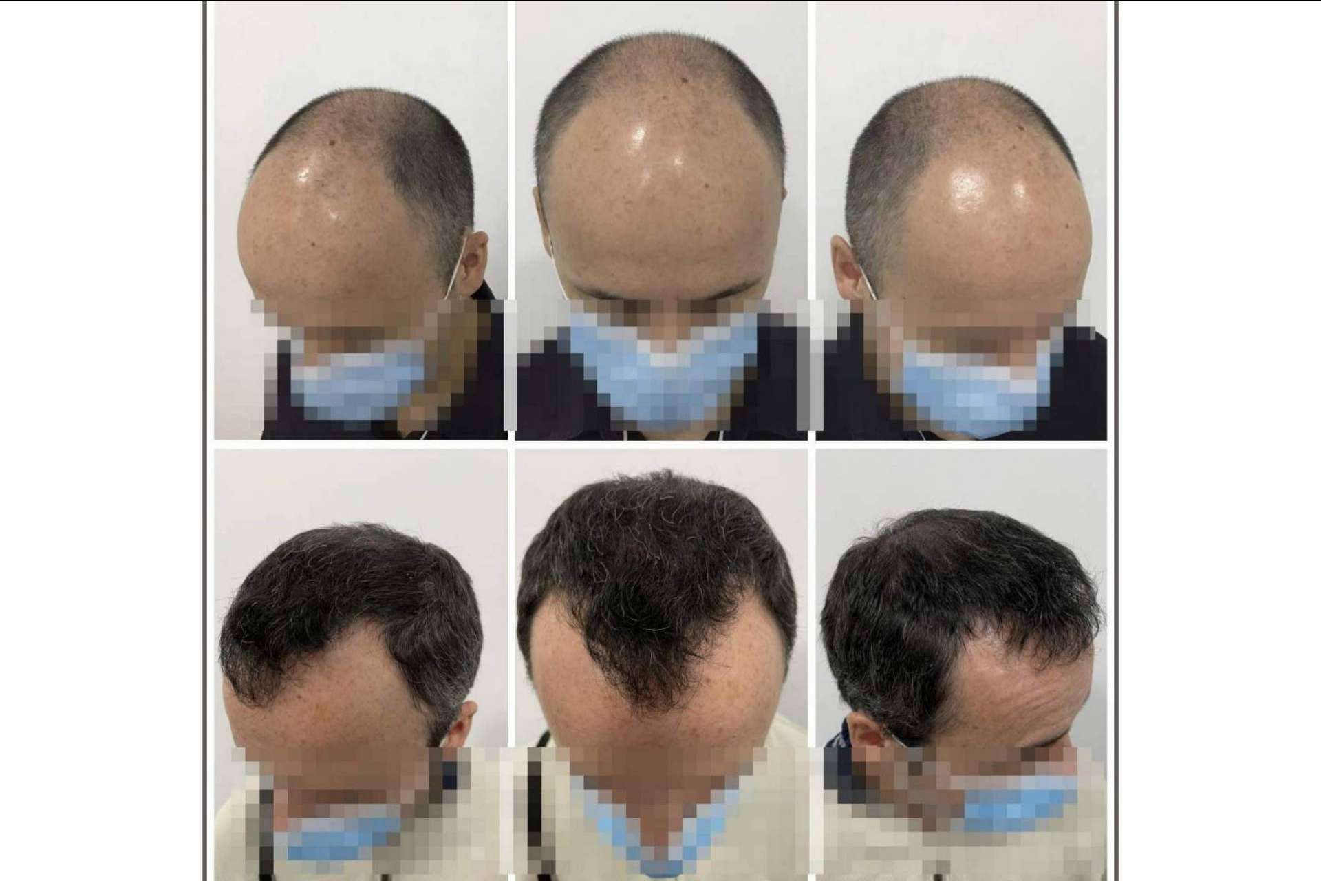 ¿En qué consiste el tratamiento de mesoterapia capilar del Dr. Bruno Jacobovski?