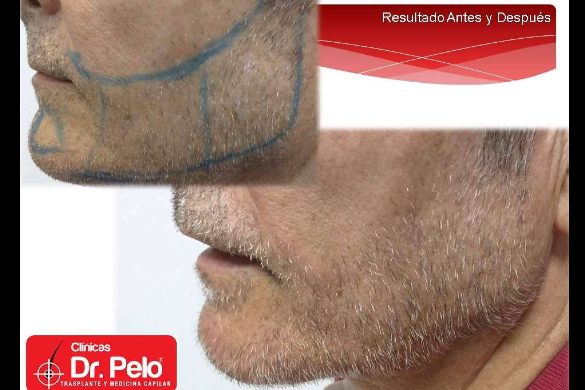 El trasplante de barba de Clínicas Dr. Pelo, uno de los tratamientos con resultados más satisfactorios