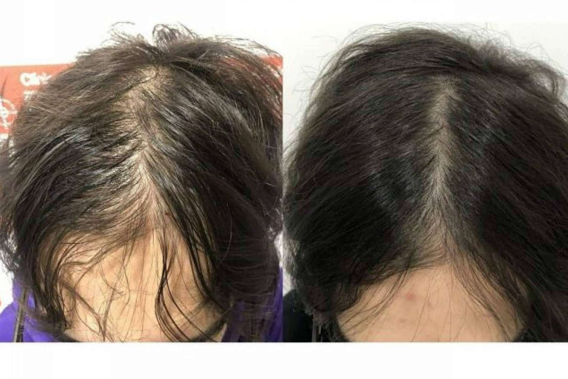 Los beneficios del láser capilar LedHair de Dr. Pelo