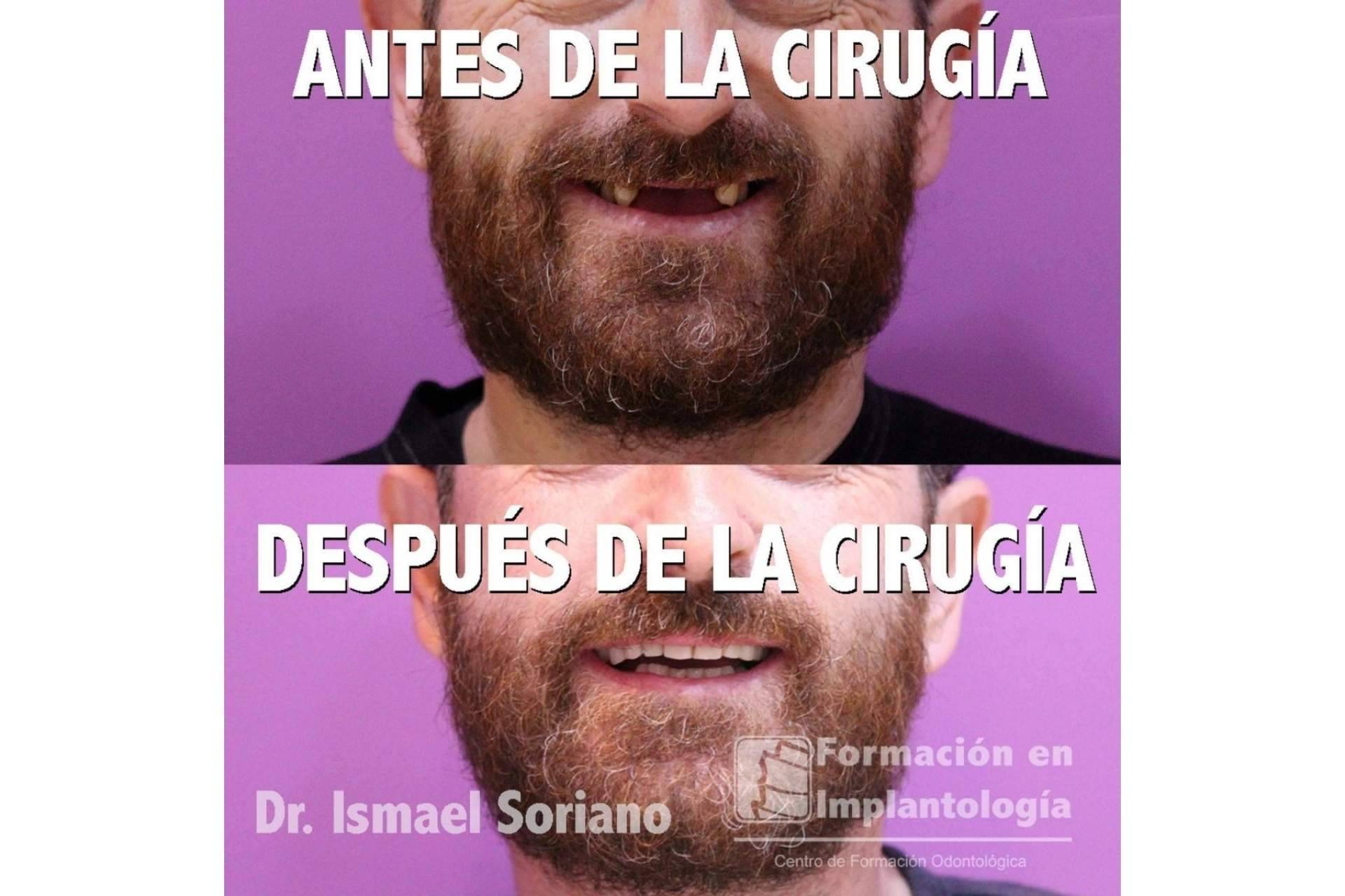 Los pacientes encuentran múltiples ventajas en la técnica de implantes con dientes inmediatos del Dr. Ismael Soriano