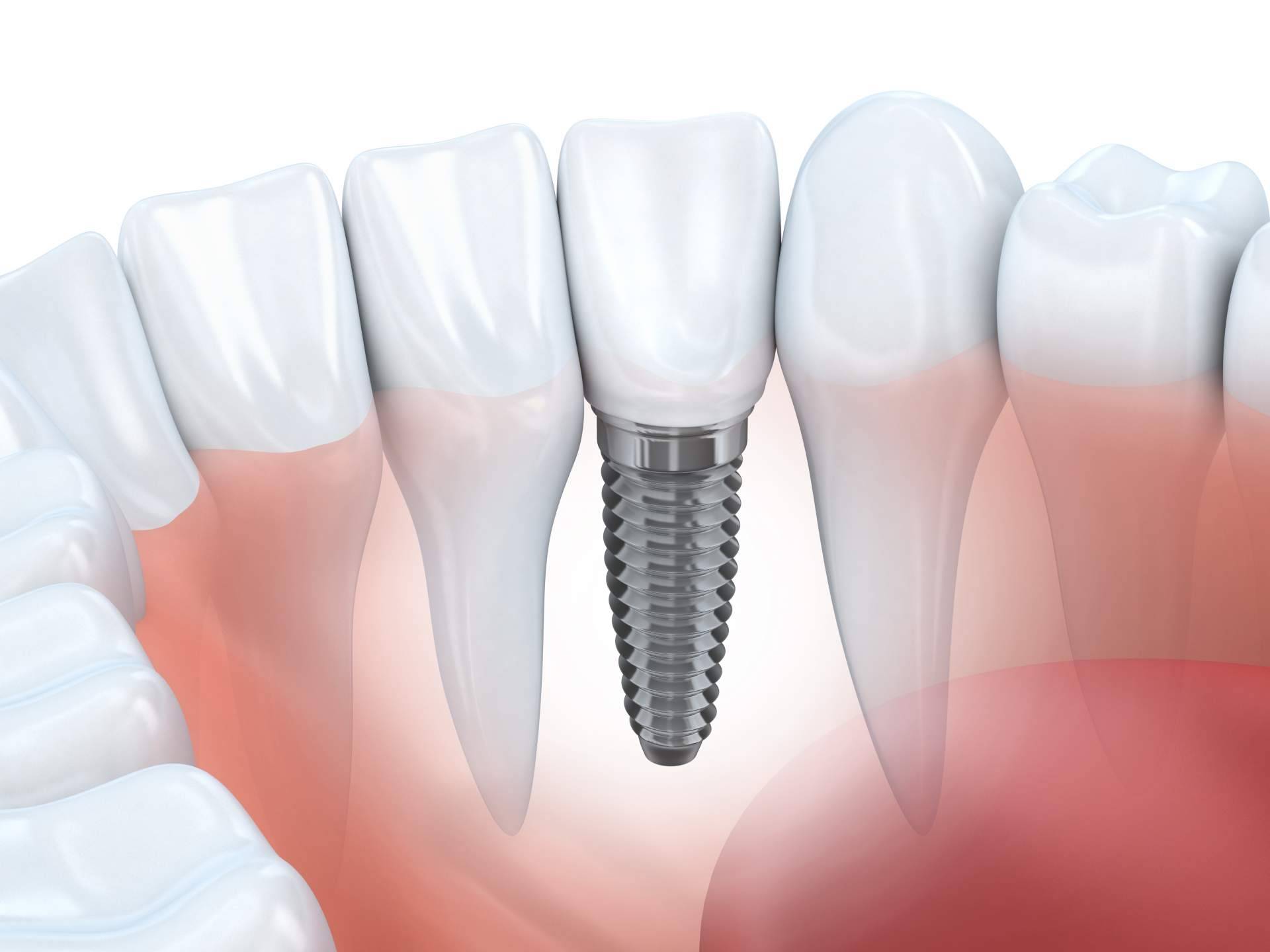 El tratamiento de implante dental de titanio en Sevilla realizado por Clínica Dental Helident