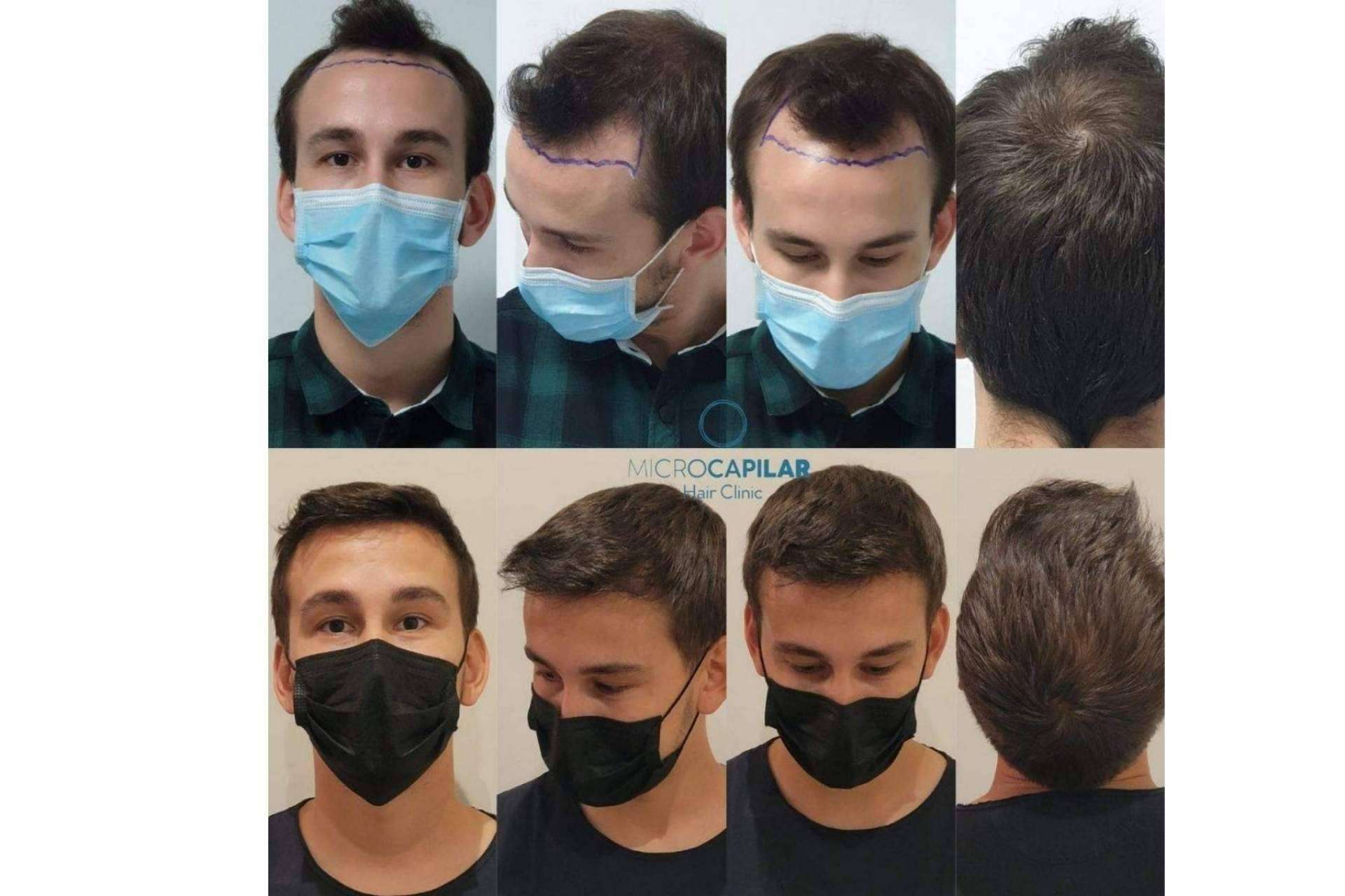 El servicio de Microcapilar Hair Clinic, las ventajas de realizar un injerto capilar en España