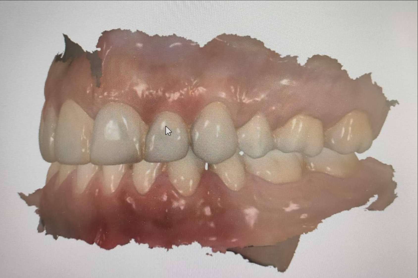 La clínica dental Implant Clinics realiza la toma de registros con 3Shape TRIOS, un escáner de última tecnología