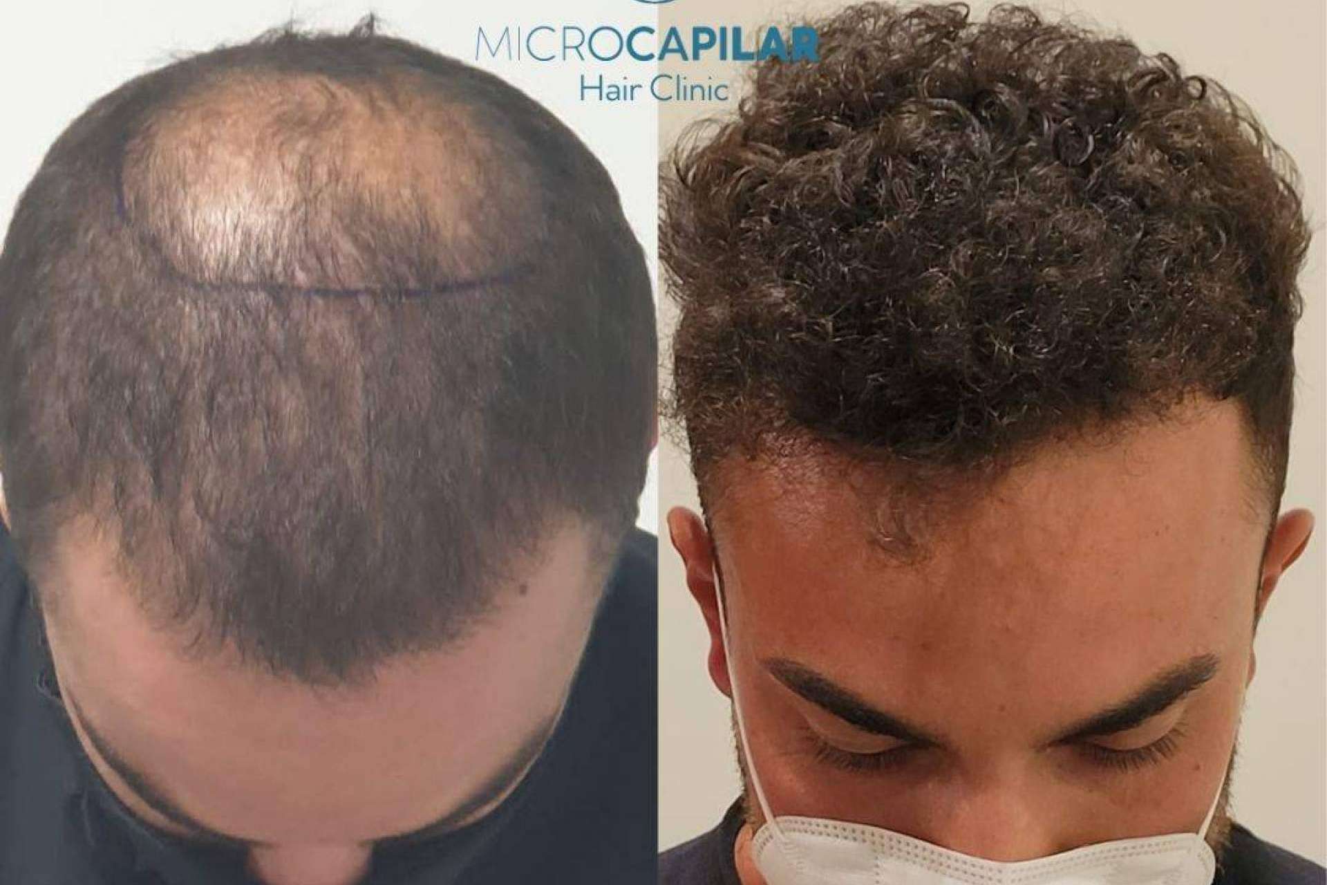El injerto capilar con máxima extracción folicular se puede realizar en lugares especializados como Microcapilar Hair Clinic