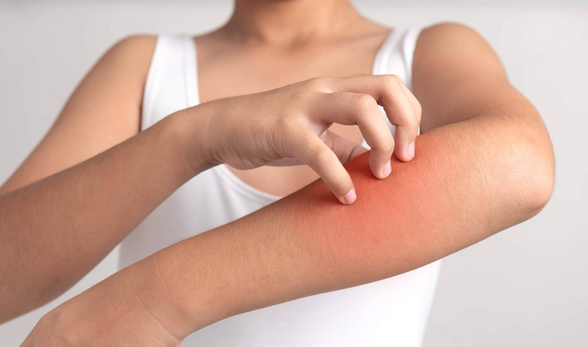 El tratamiento natural psoriasis corporal sin cortisona de Laboratorio Géomer