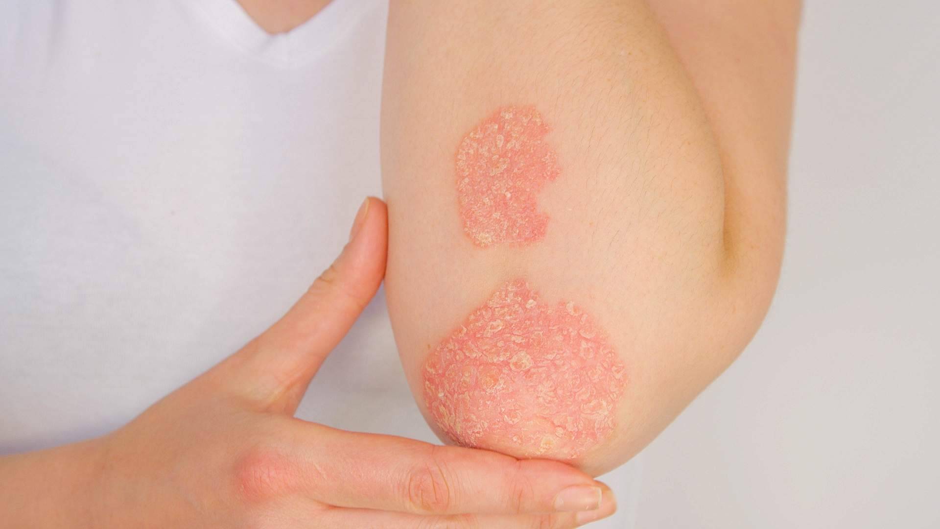 Tratamiento efectivo para la psoriasis con los productos de Soriasel
