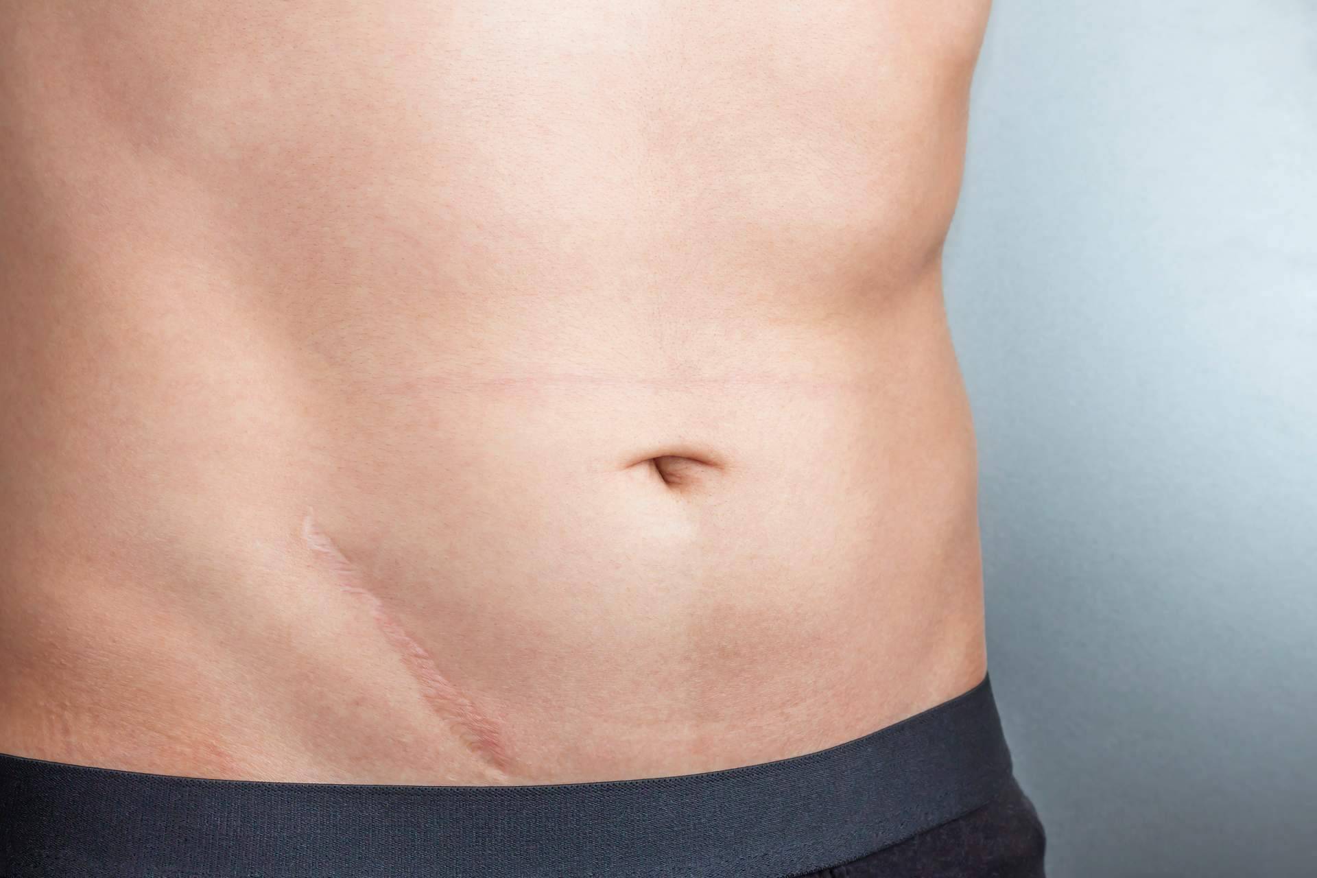 Optar por la fisioterapia y la osteopatía en el tratamiento de cicatrices y liberación de adherencias