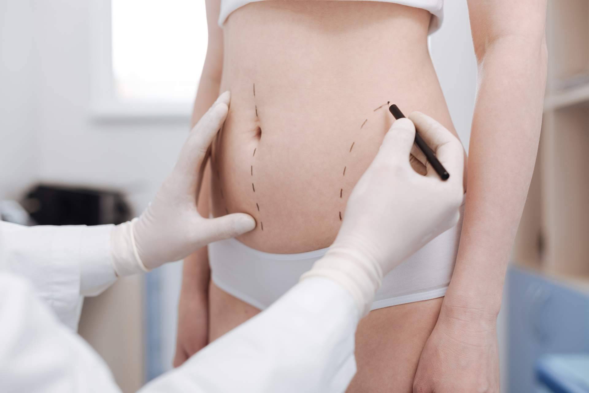 Los beneficios del tratamiento de Velashape III de la Dra. Rigo