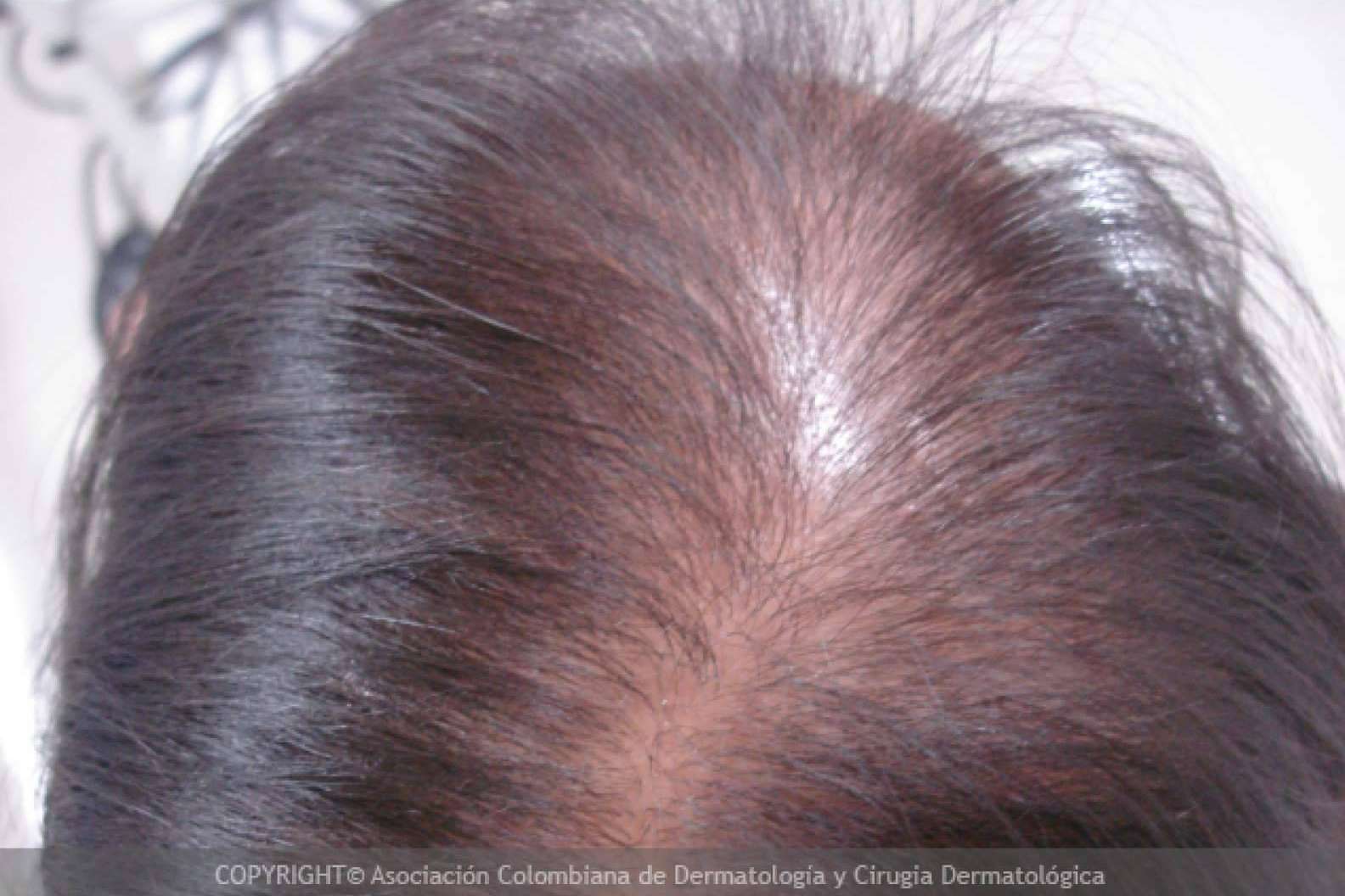 Tipos de alopecia femenina y métodos para combatirla según la clínica Injermur