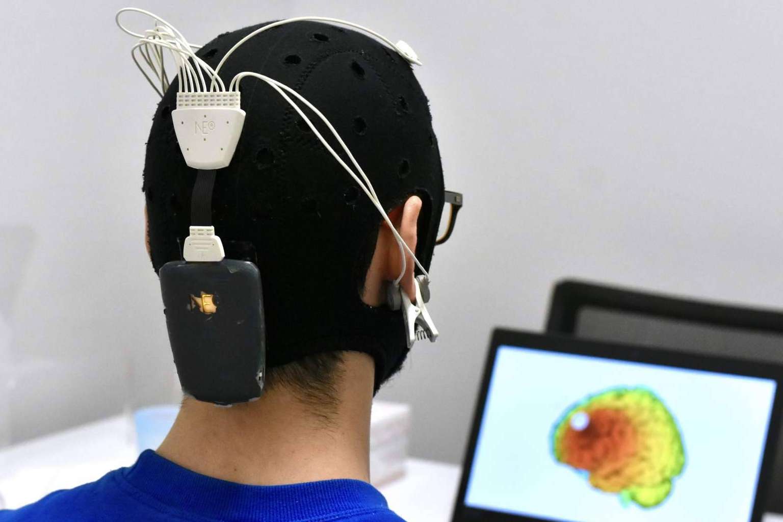 Recuperación tras sufrir un ictus gracias a los tratamientos de neuromodulación