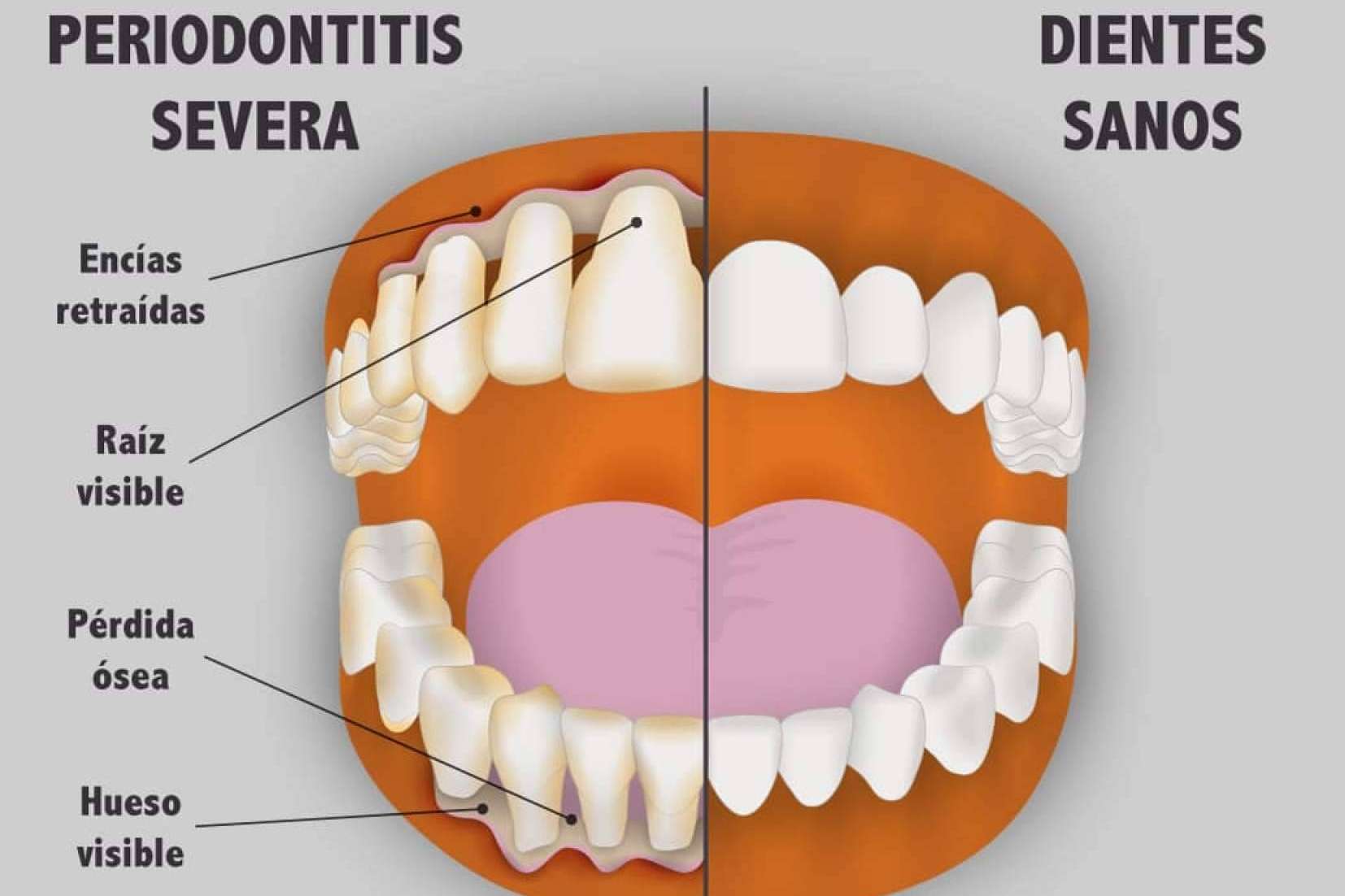 Enfermedad periodontal, ¿qué es y cómo tratarla?, por Implant Clinics