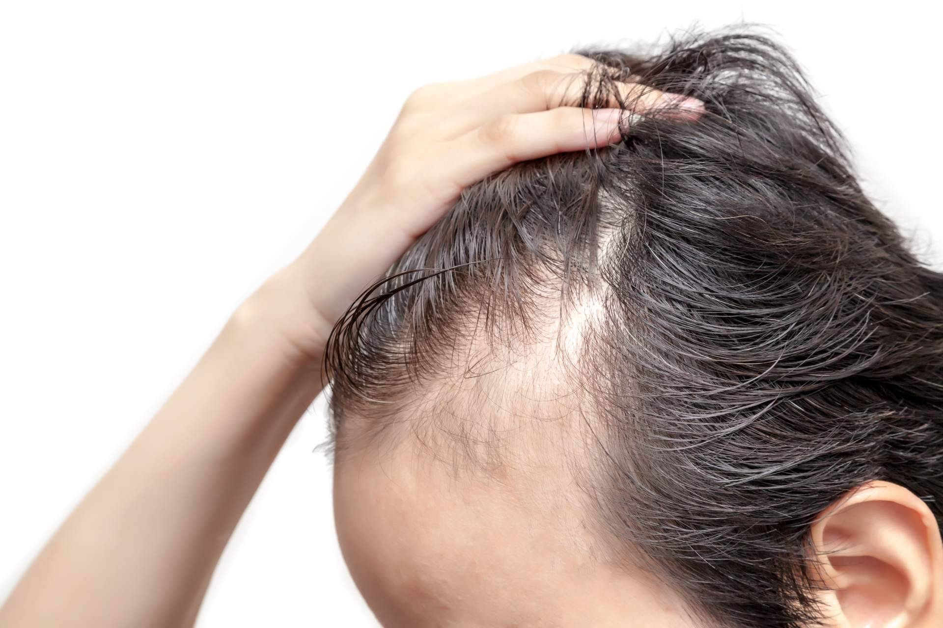 Combatir la alopecia androgénica gracias a Saw Palmetto