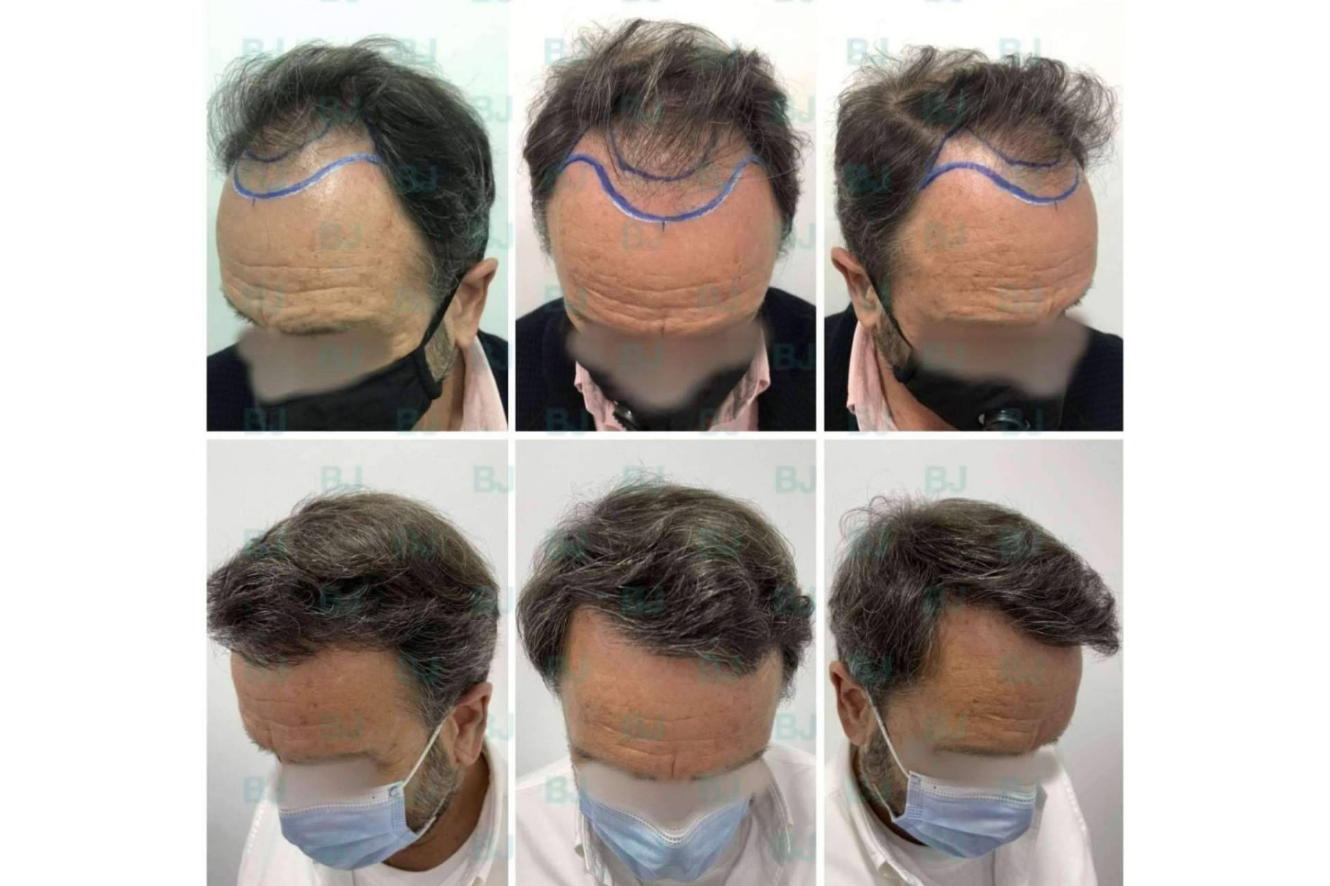 Las diferencias de las técnicas de implante capilar FUE y FUSS, en la clínica capilar de Dr. Bruno Jacobovski