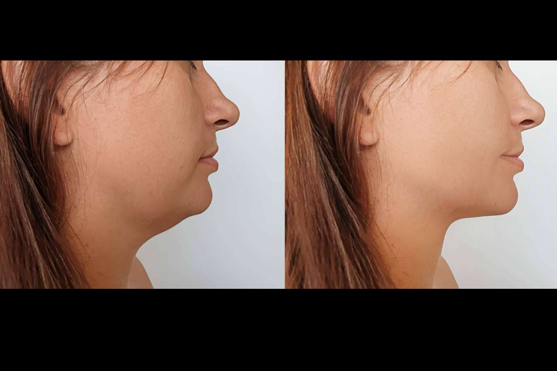 Clínica Femme permite eliminar la papada y la flacidez facial con el lifting láser