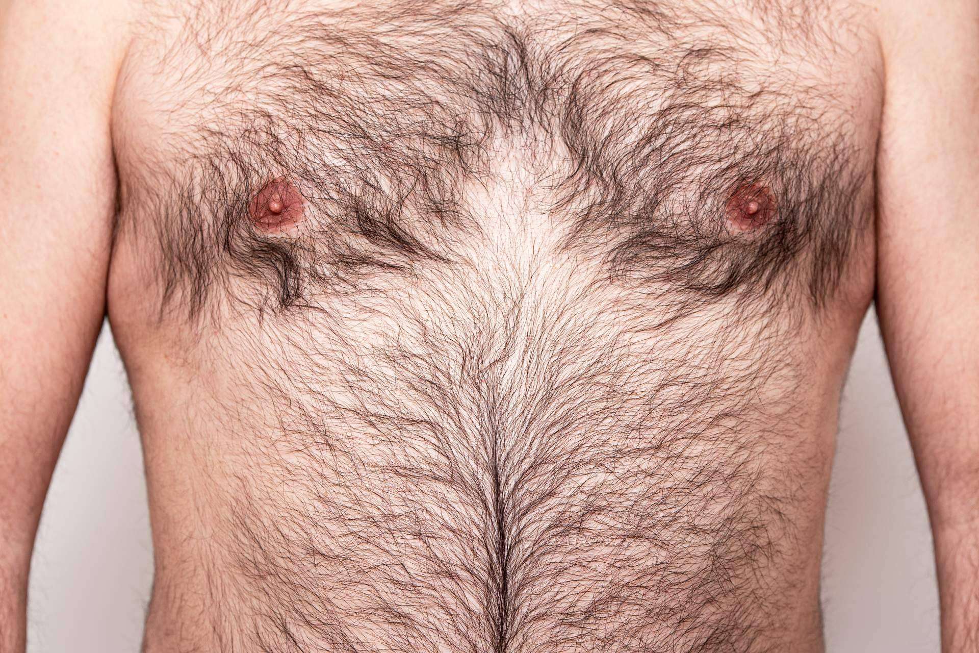 Body Hair es una técnica de injerto capilar desde otras zonas del cuerpo para alopecia avanzada