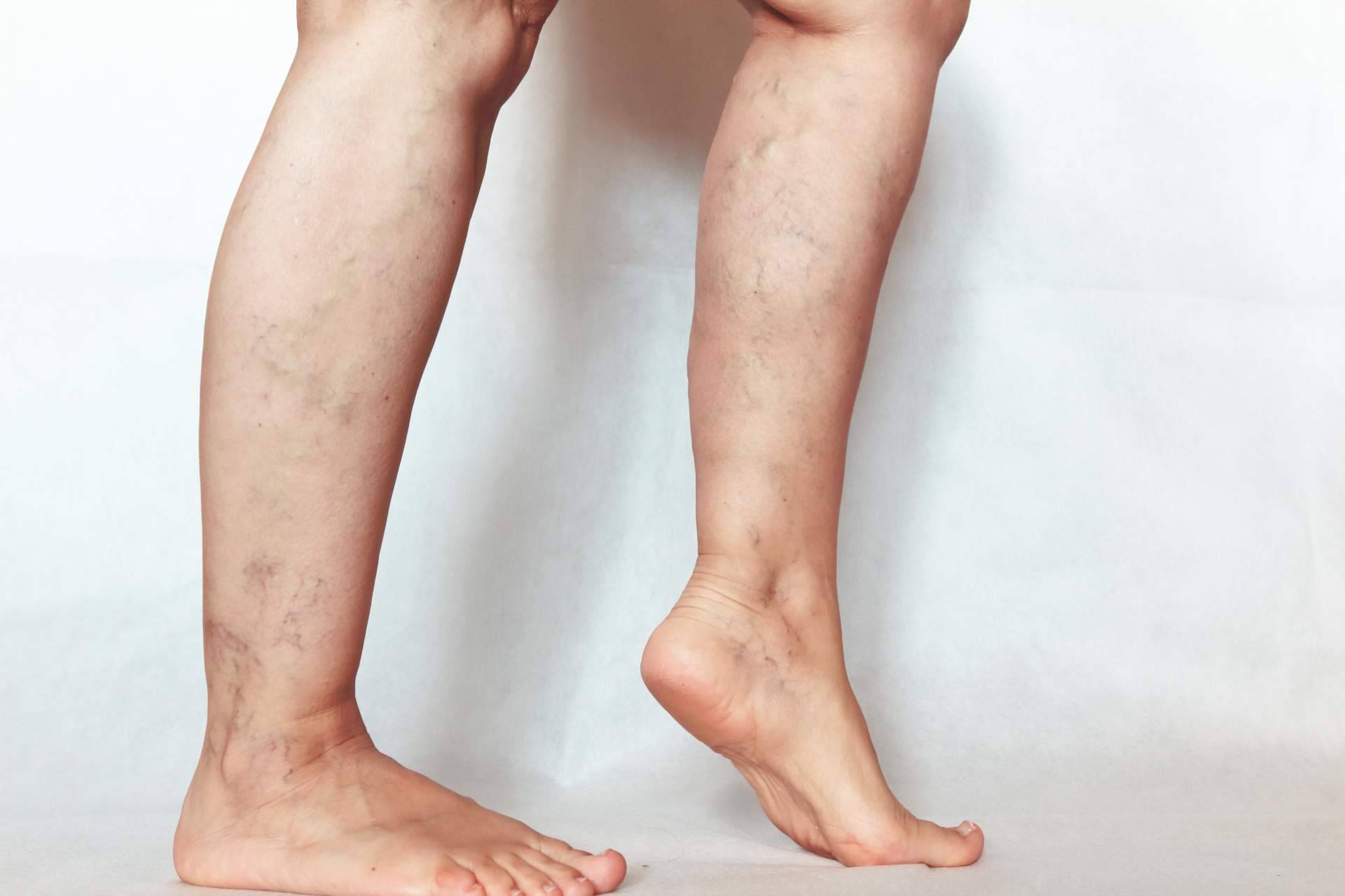 Cómo la fisioterapia puede ayudar a mejorar los síntomas de las patologías del sistema vascular periférico
