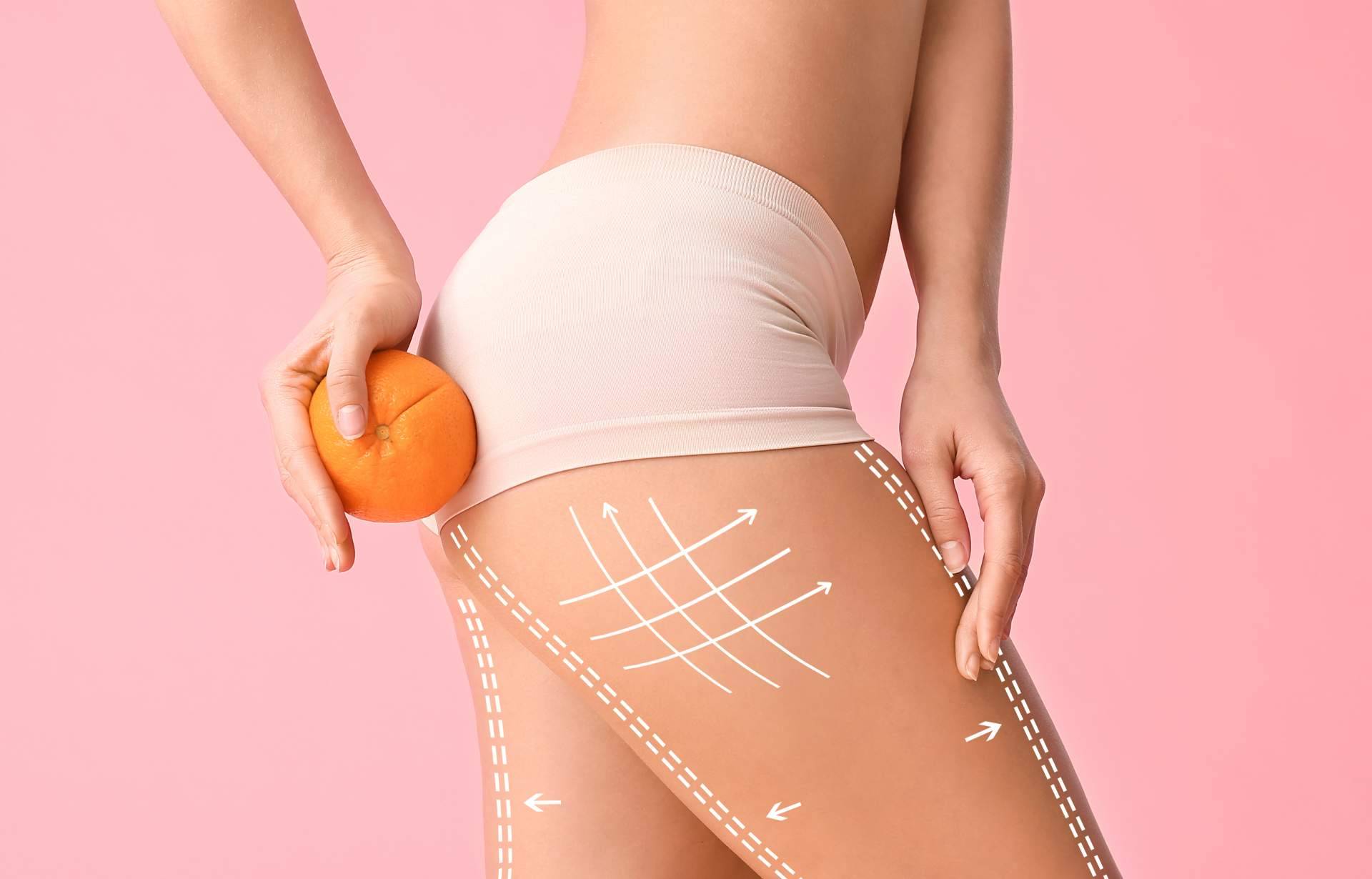 Las 6 acciones contra la celulitis, según el Laboratorio Géomer