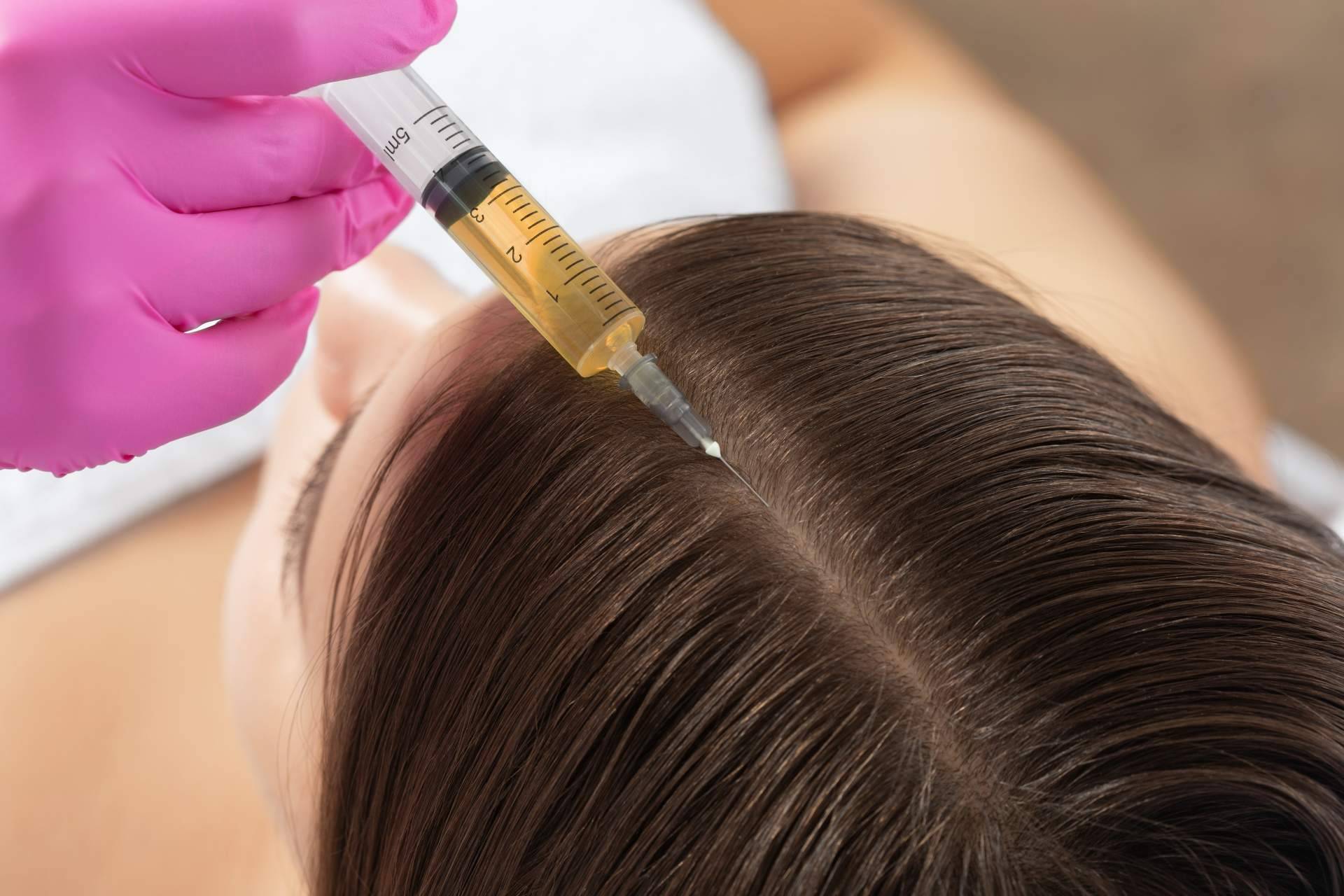 Vitaminas, mesoterapia capilar y plasma rico en plaquetas
