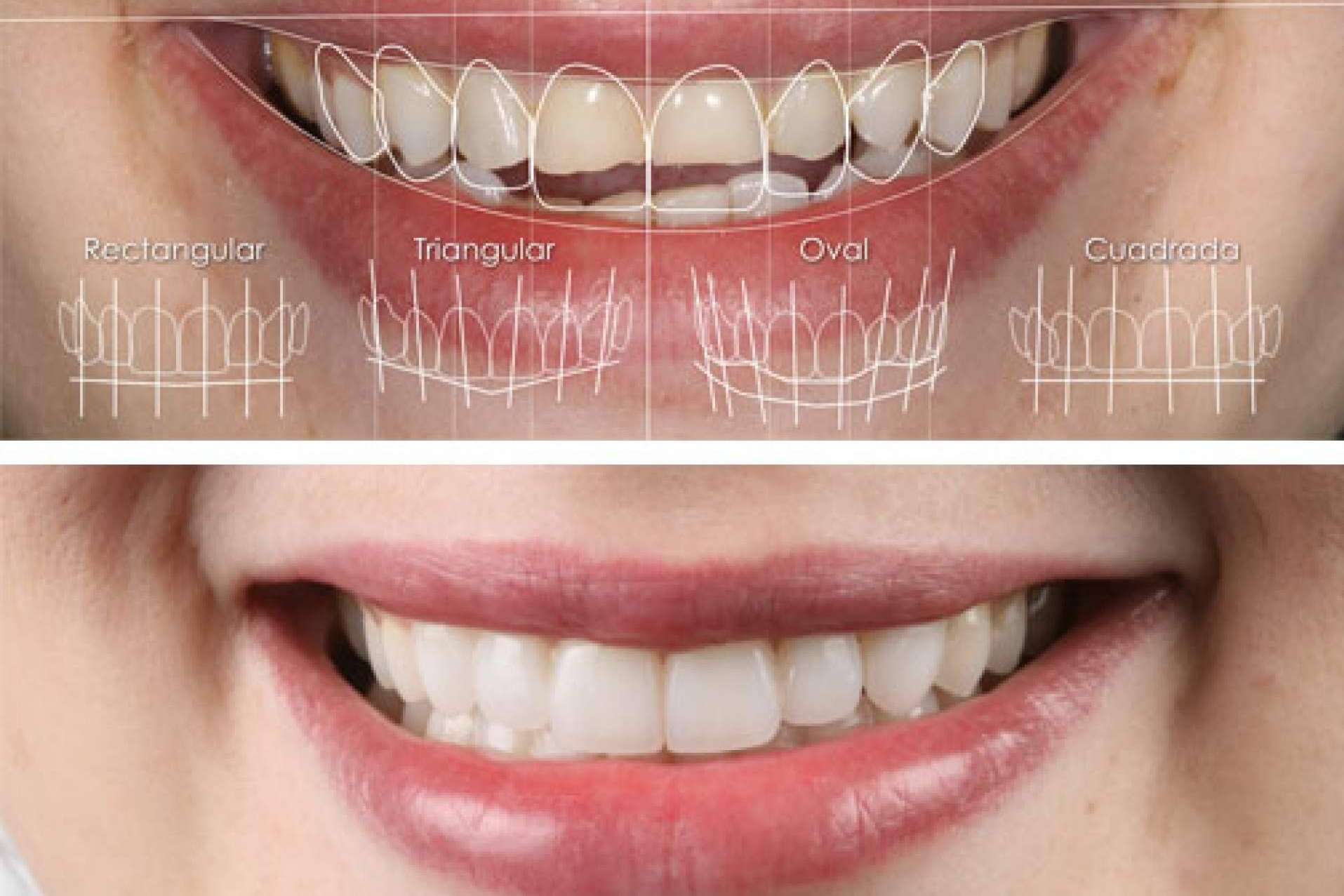 Las carillas dentales son uno de los recursos favoritos por los expertos en estética dental, por Clínica Dental Ruiz de Gopegui