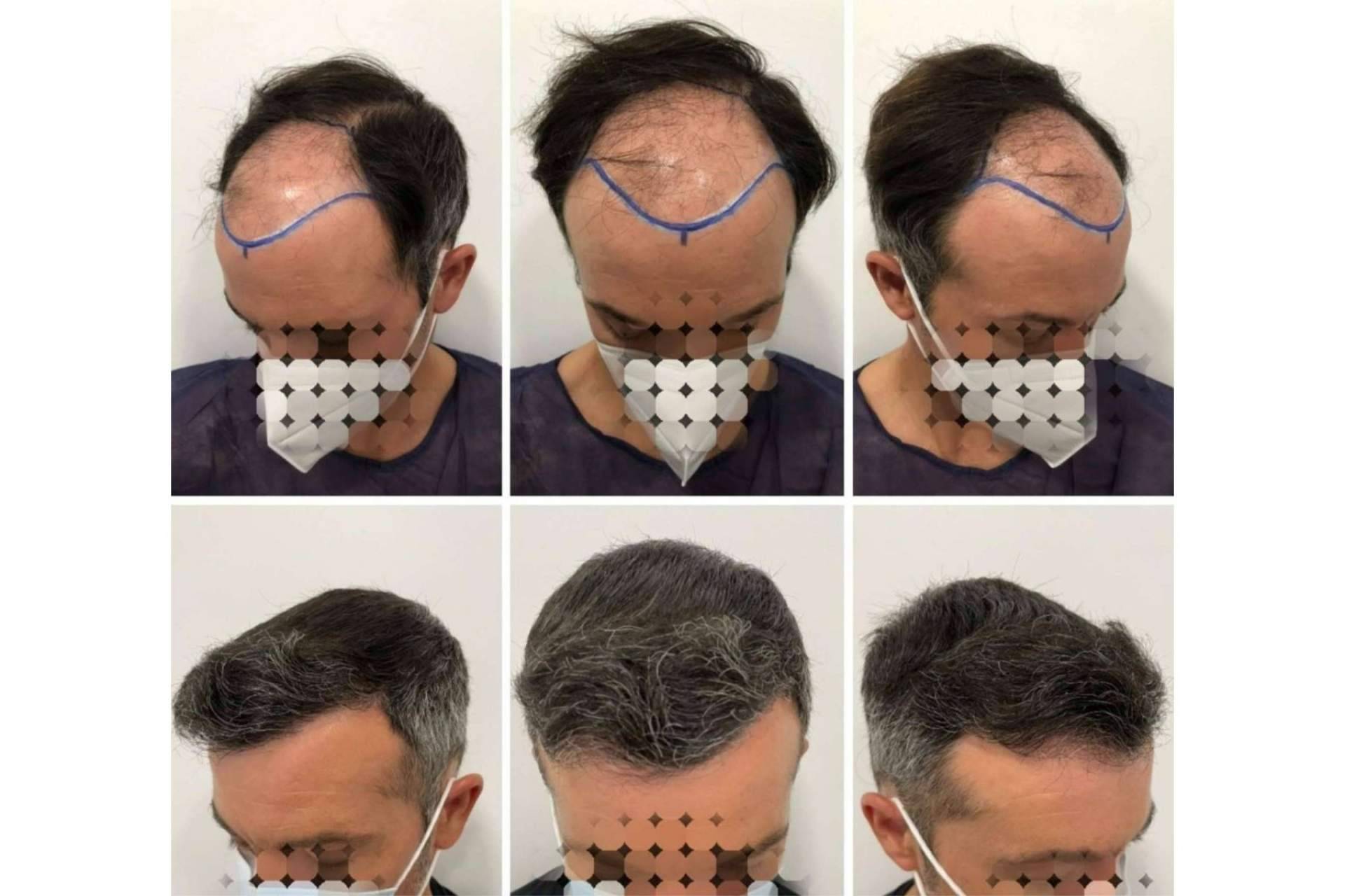 La evolución del injerto capilar día a día después de someterse a un implante capilar de la mano del Dr. Bruno Jacobovski