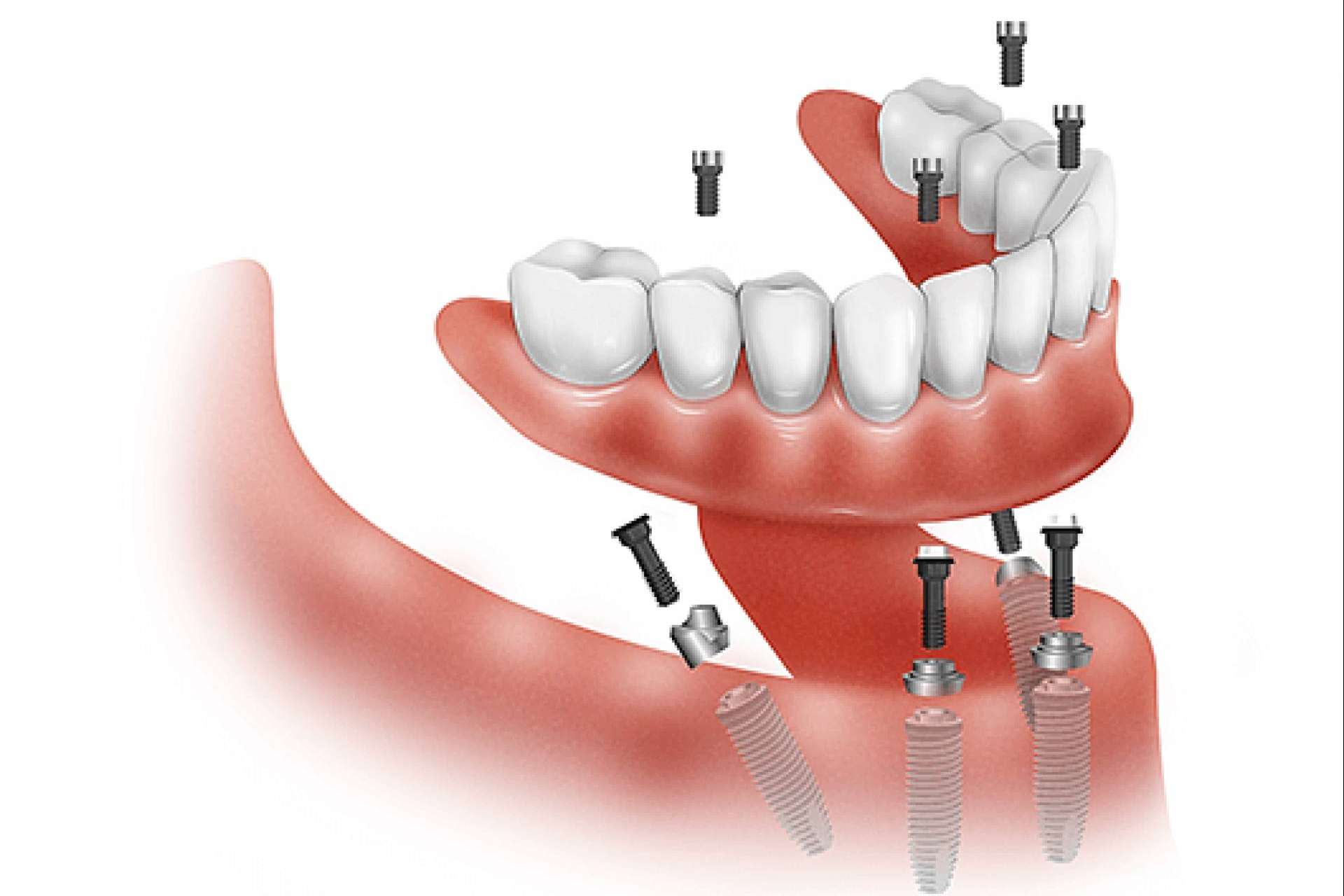 Las prótesis dentales híbridas All On 4 y All On 6 devuelven la sonrisa en 24 horas