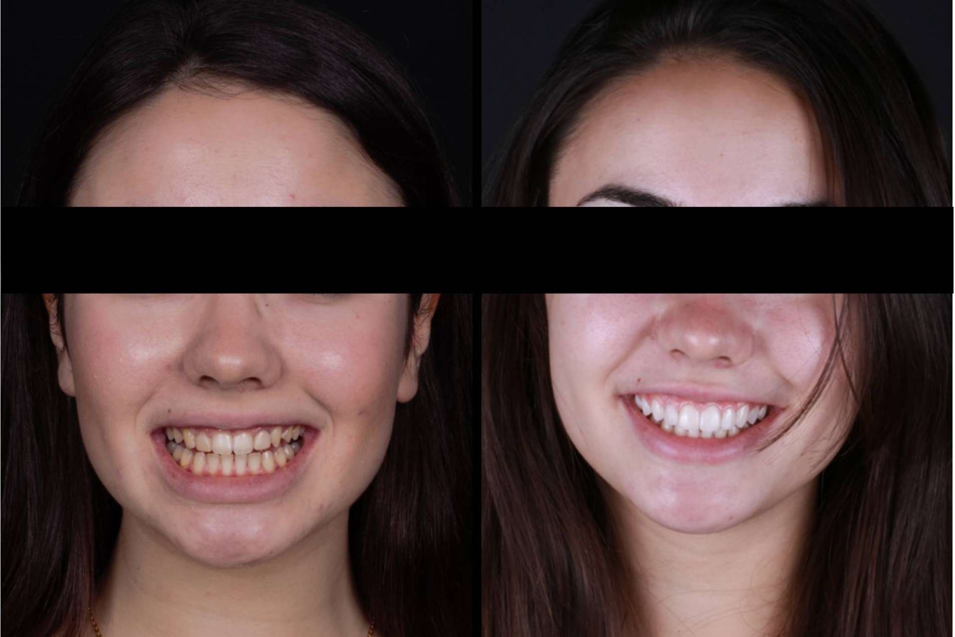 ¿Cuáles son las ventajas de las carillas dentales?, por los profesionales de Carillas Wikend®