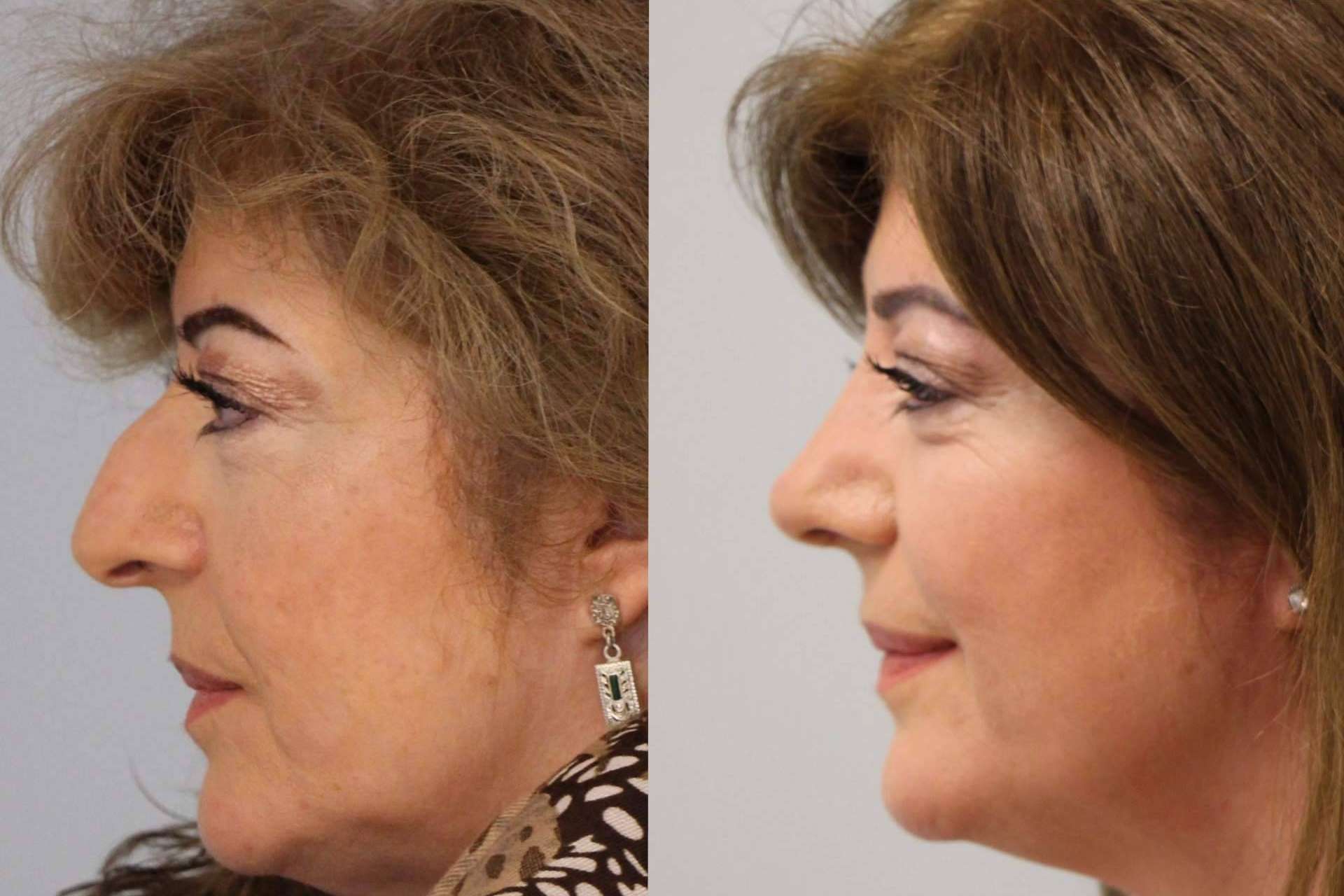 ¿Qué se debe hacer antes de pasar por una rinoplastia ultrasónica?, por el Dr. Pérez Villar