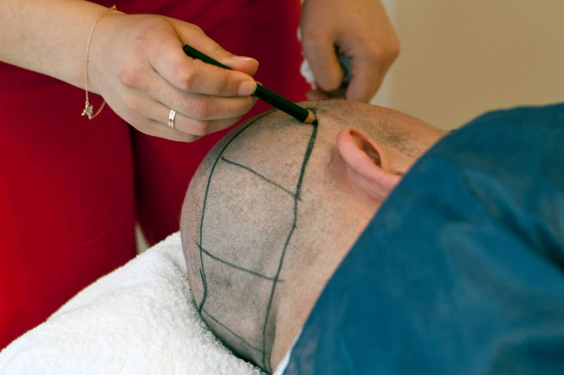 Microinjerto capilar en Madrid de la mano del Dr. Antonio Fernández Brito en Microcapilar Hair Clinic
