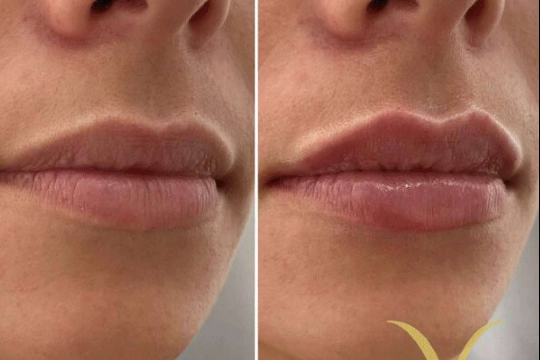 Adiblips, la técnica de la Clínica Yasmin para el aumento de labios con ácido hialurónico