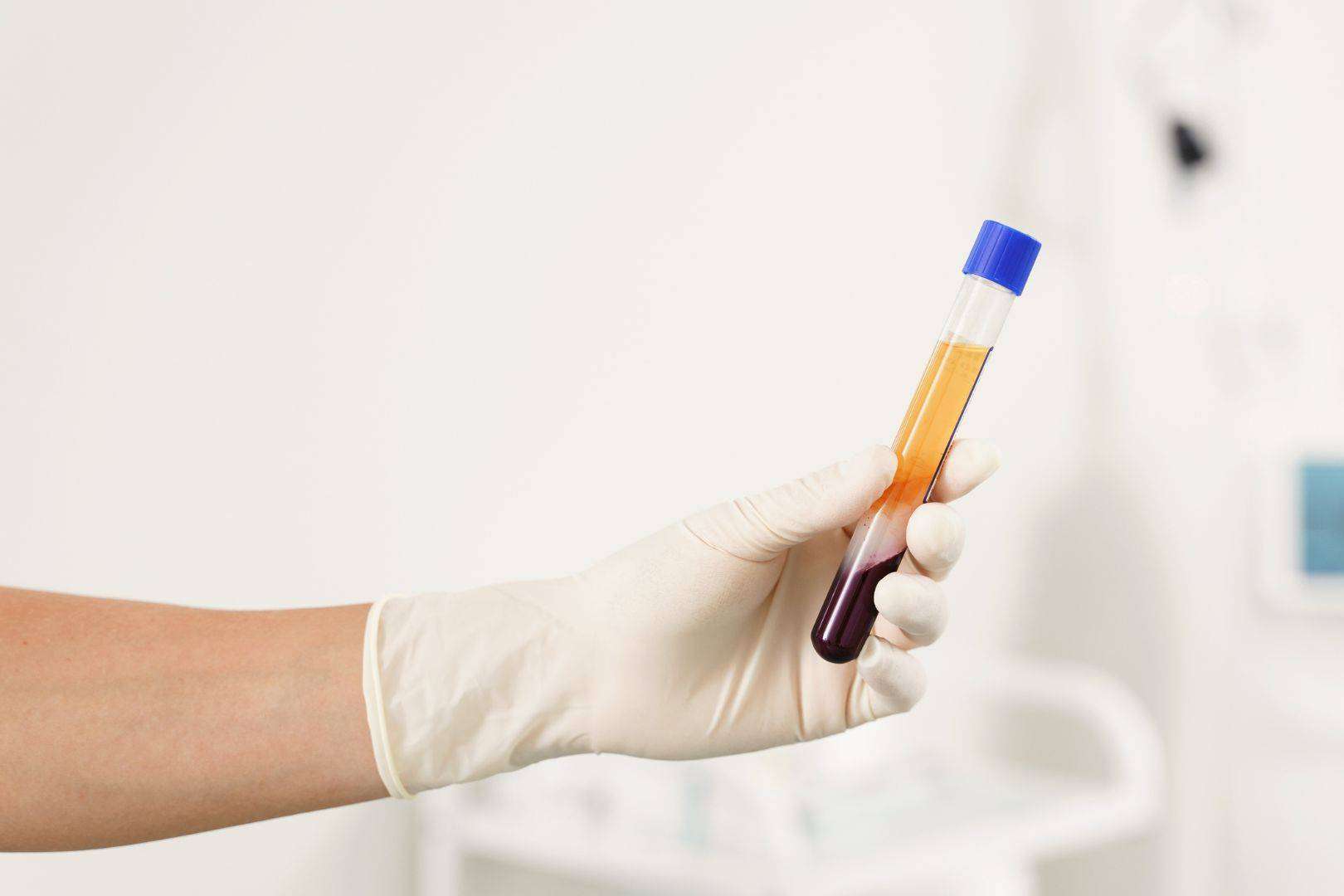 Plasma rico en plaquetas y dutasterida, la potente terapia regenerativa de doble efecto contra la caída del cabello