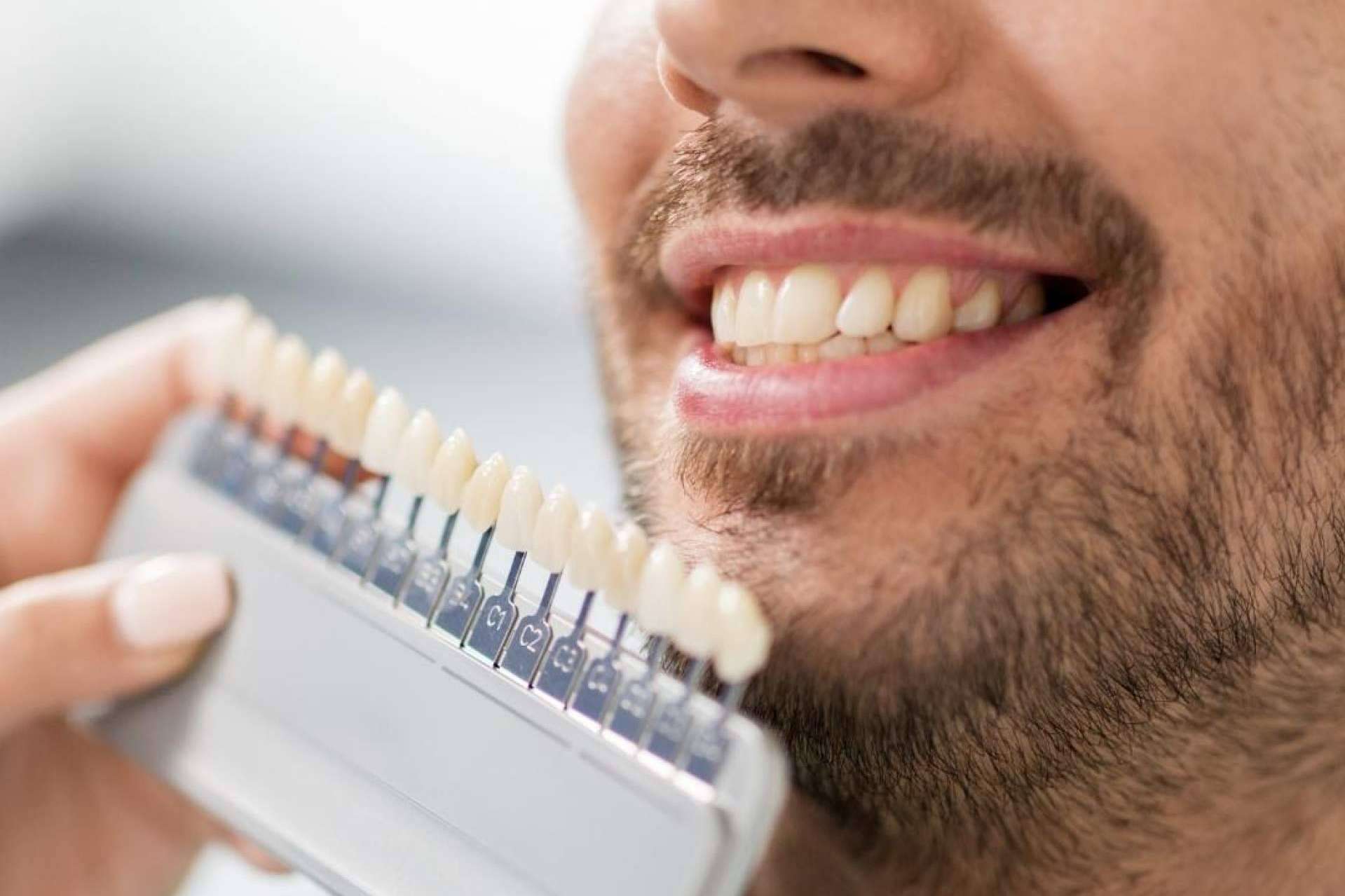 Todo lo que se debe saber sobre las carillas dentales, por Crespí & Gandía