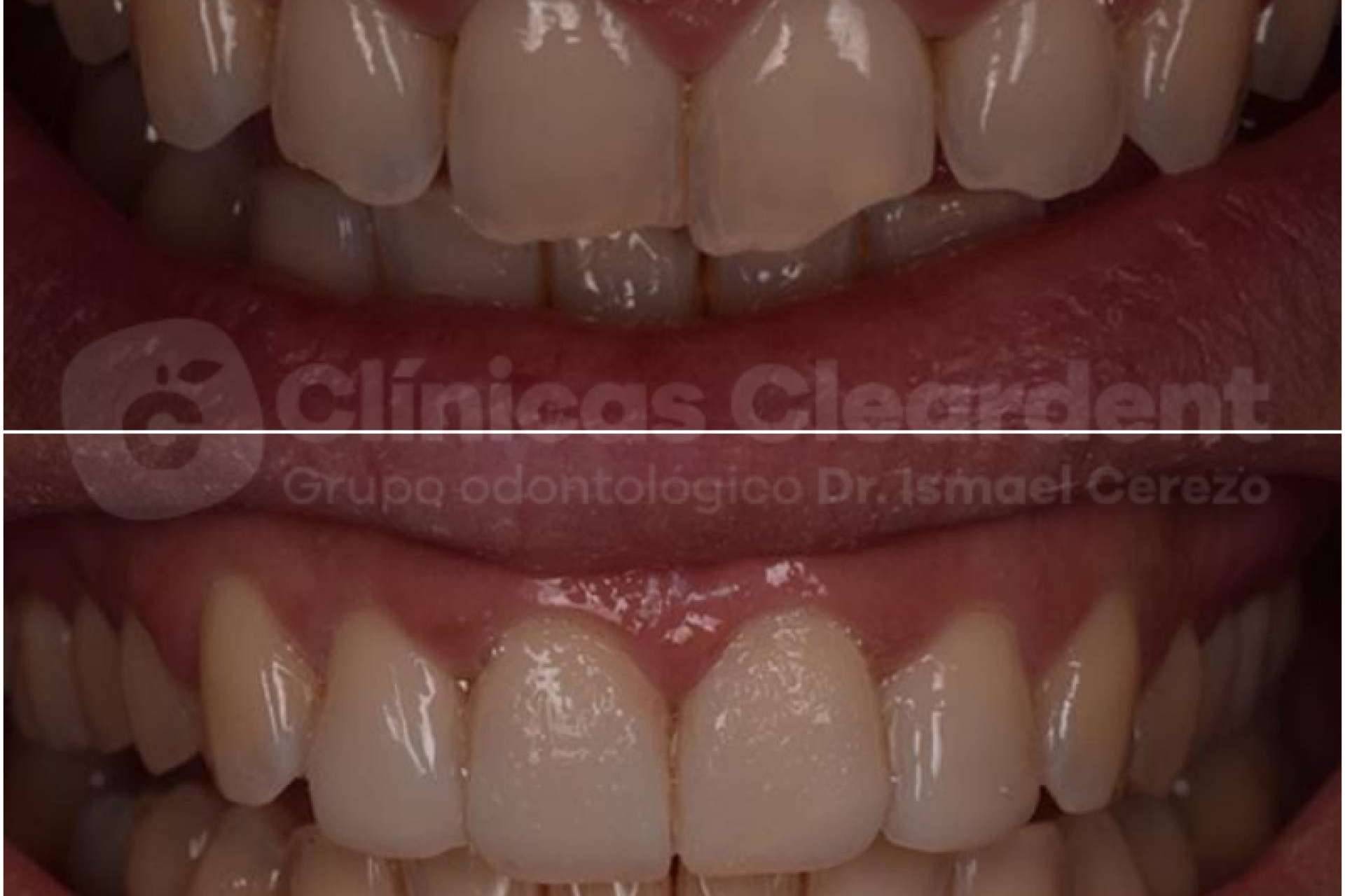 ¿Para qué sirven las carillas dentales?, las opciones que ofrece Cleardent